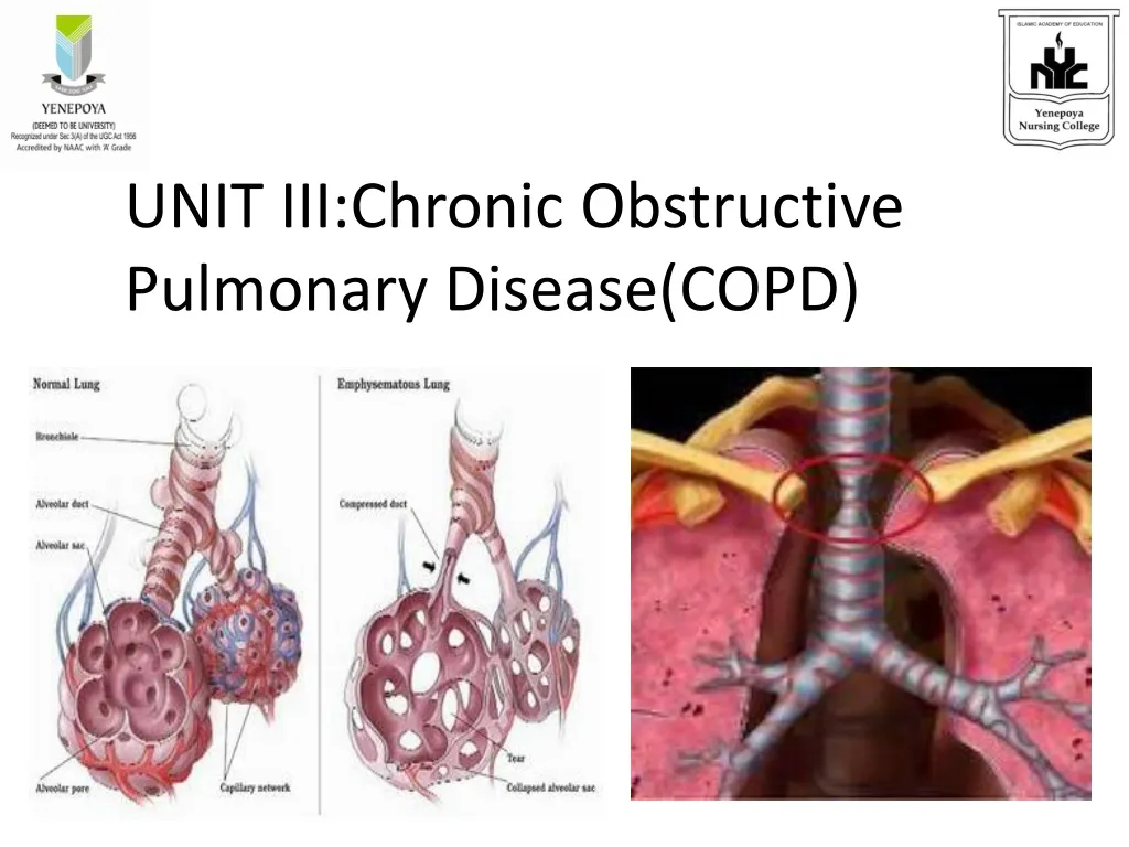 Ppt Unit Iii Chronic Obstructive Pulmonary Disease Copd Powerpoint Presentation Id
