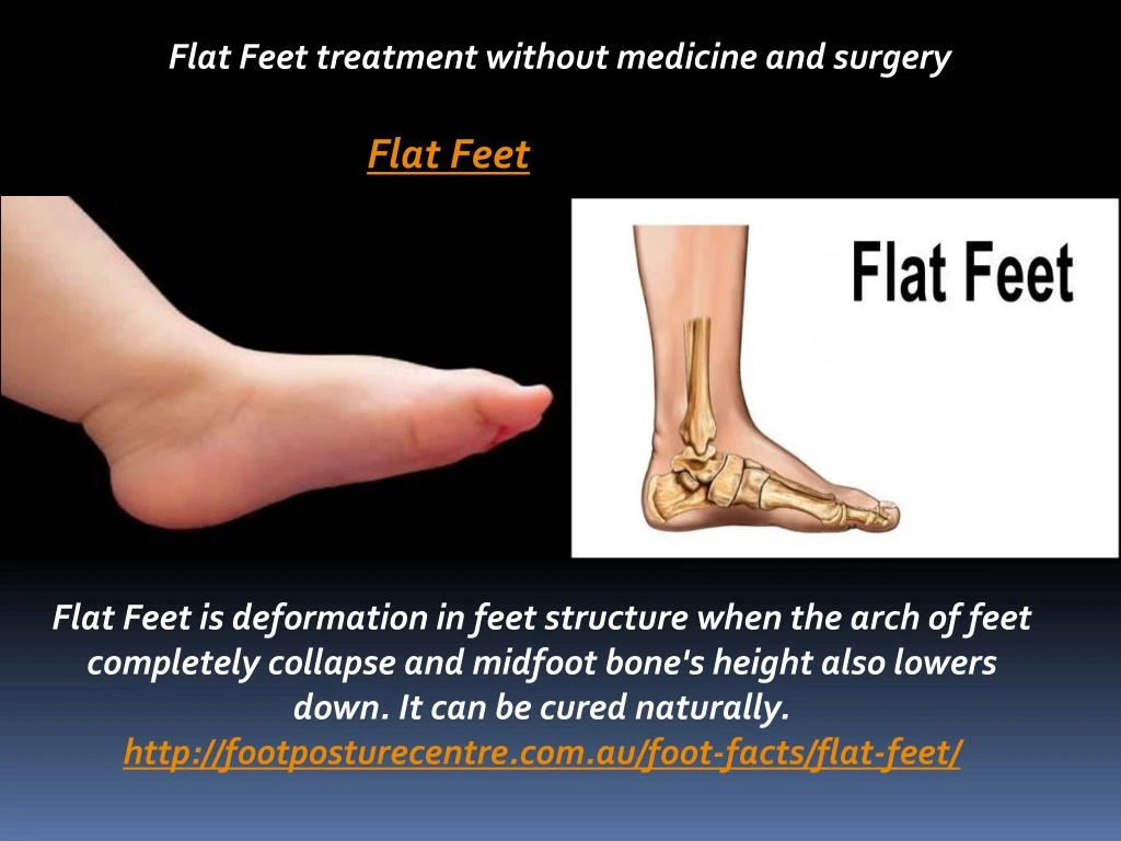 flat feet treatments