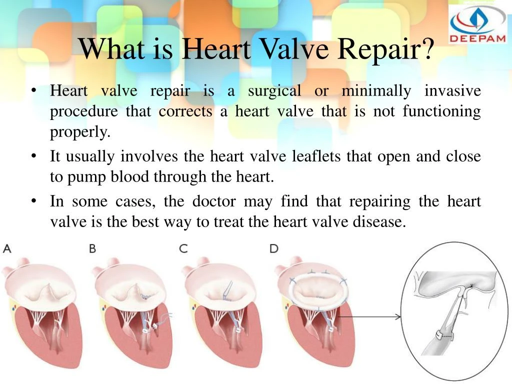 ppt-avr-mvr-all-you-need-to-know-about-valve-repair-replacement