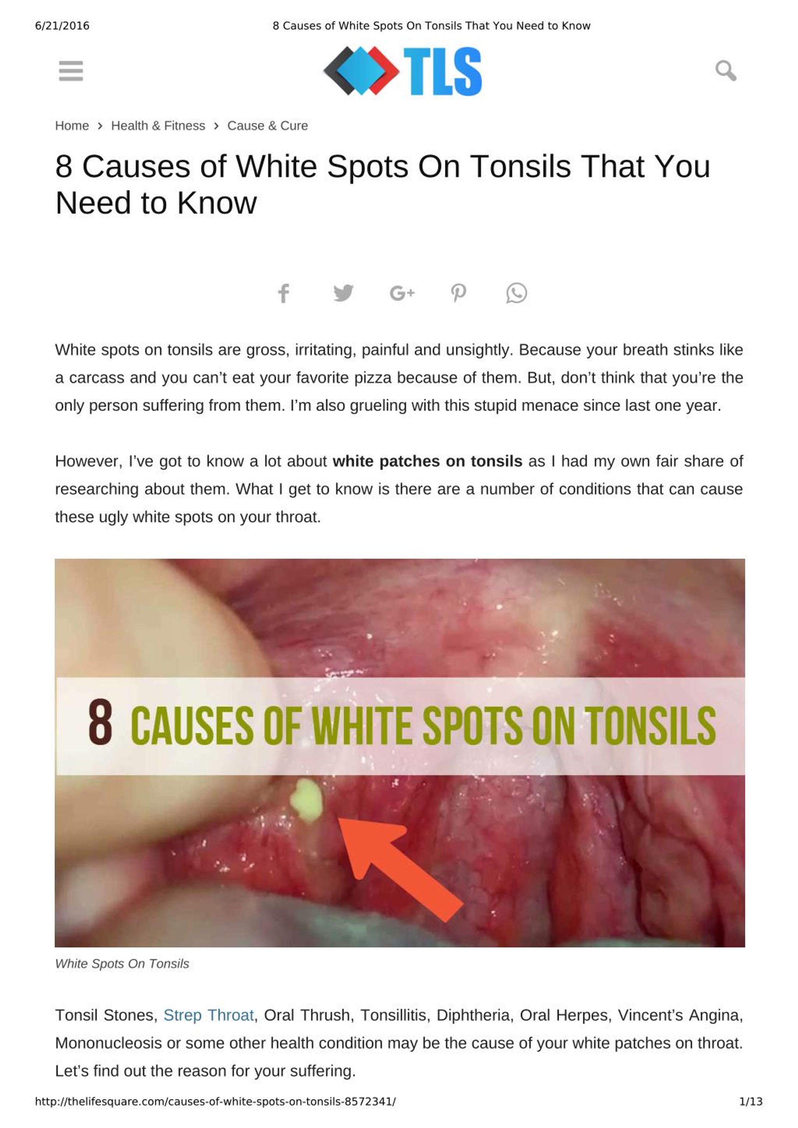 Ppt Causes Of White Spots On Tonsils You May Not Know Powerpoint