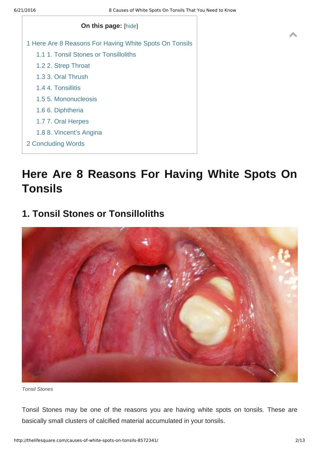 Ppt 8 Causes Of White Spots On Tonsils You May Not Know Powerpoint