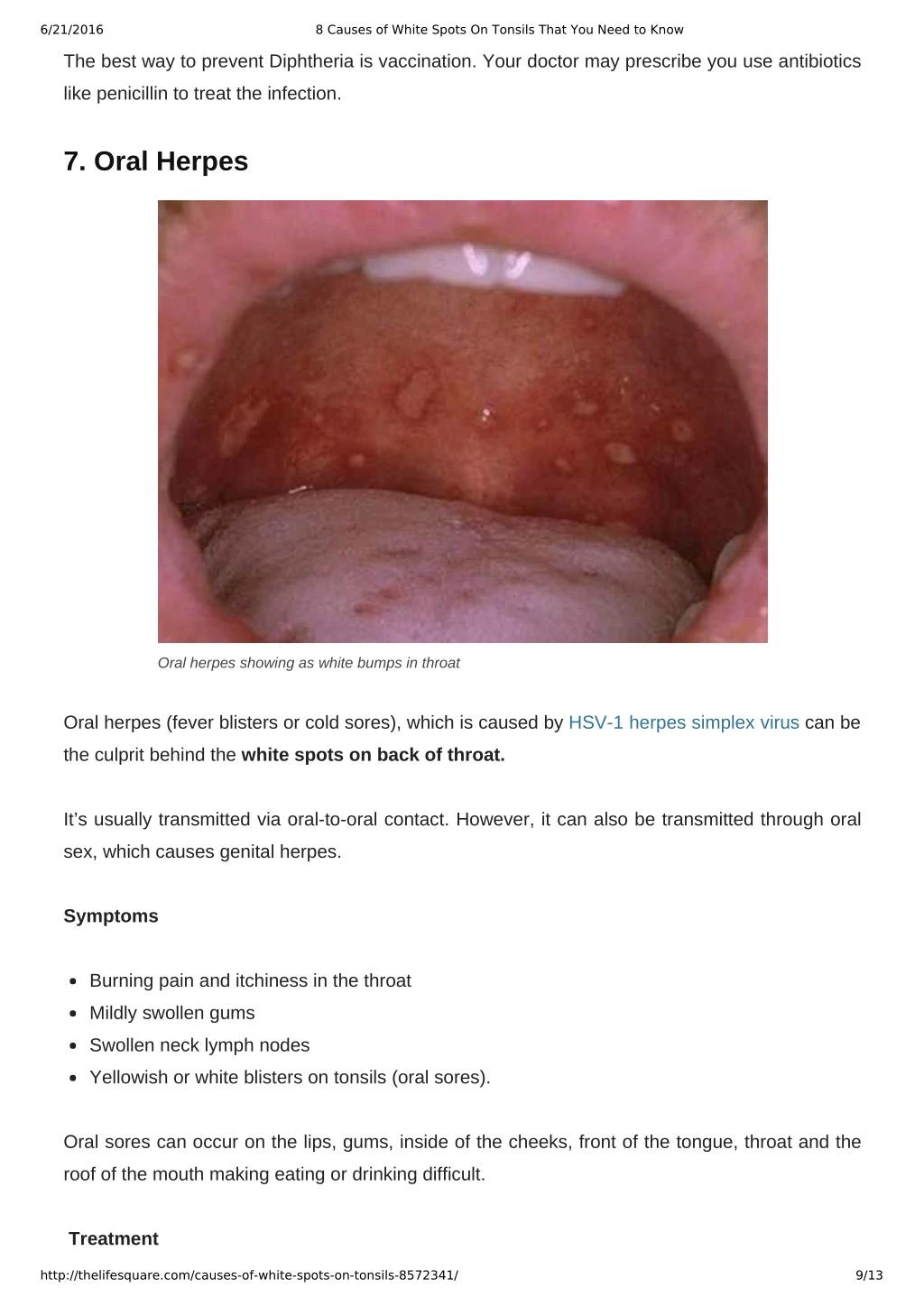 Ppt 8 Causes Of White Spots On Tonsils You May Not Know Powerpoint