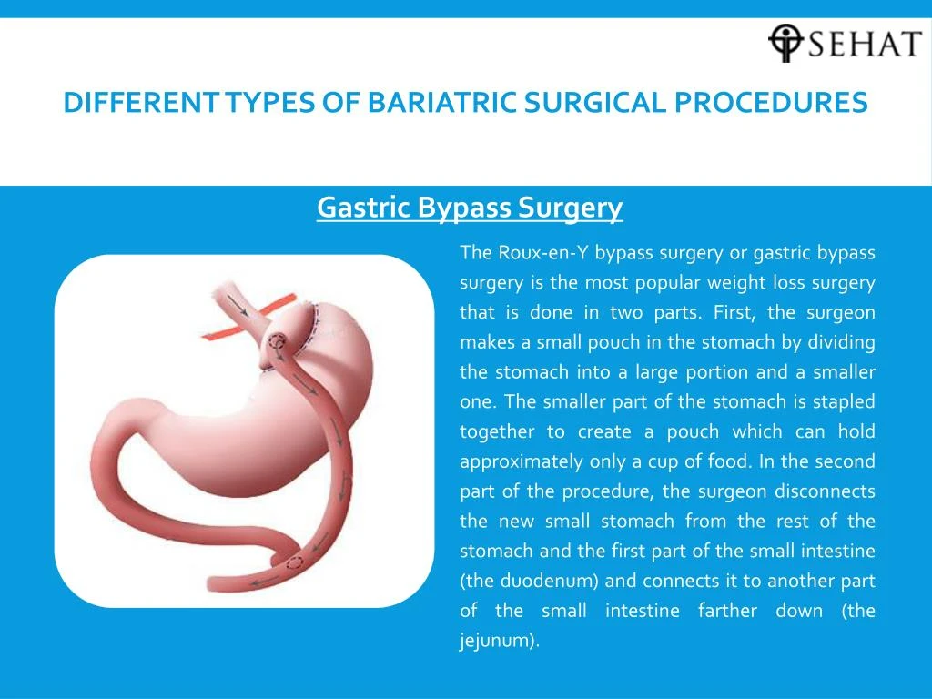 ppt-bariatric-surgery-procedure-powerpoint-presentation-id-7365340