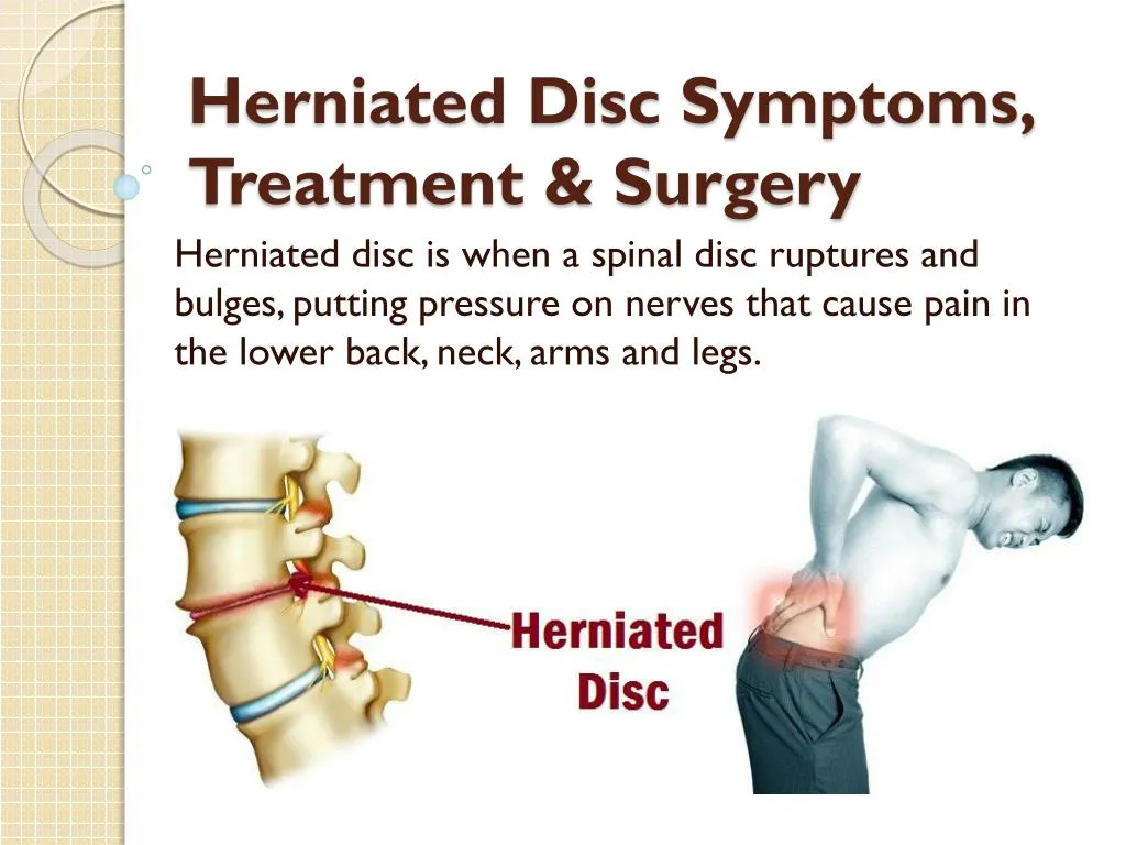 PPT - Herniated Disc Symptoms, Treatment & Surgery PowerPoint ...