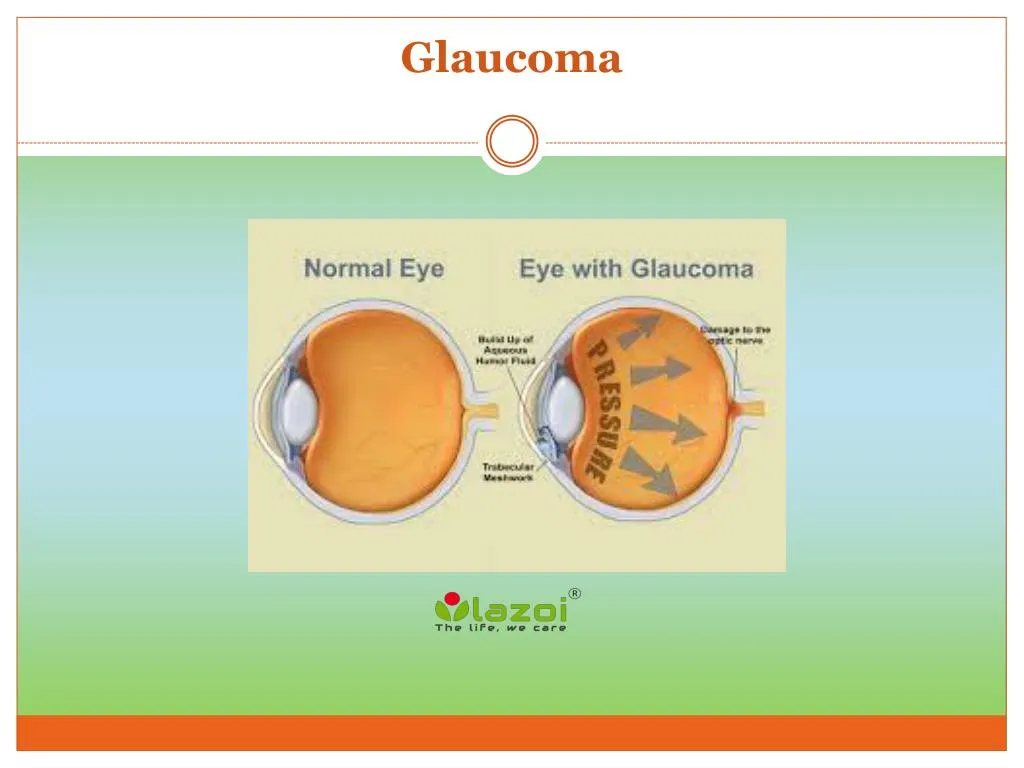 Ppt An Overview Of Glaucoma Symptoms Causes And Treatment Powerpoint