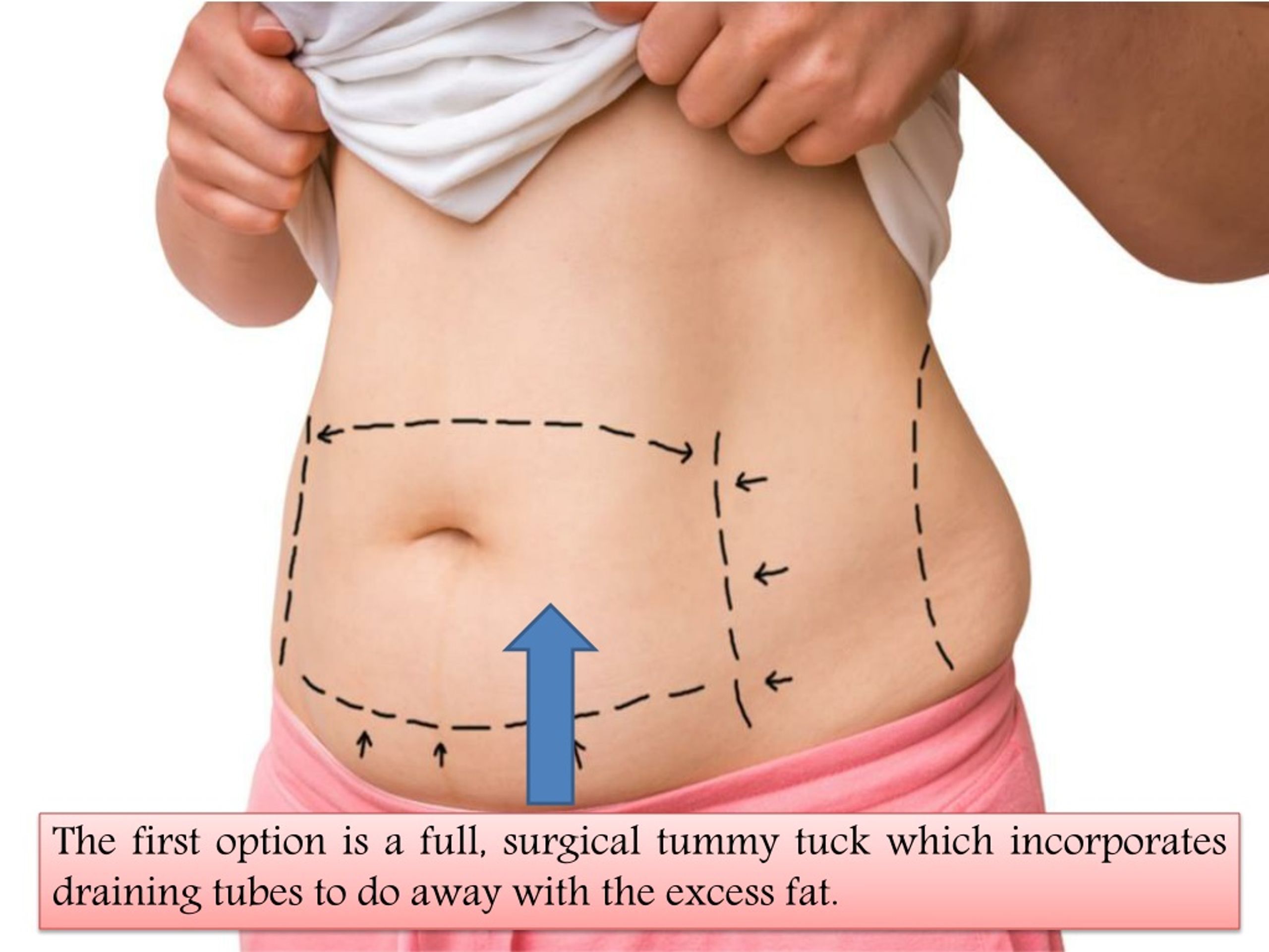 PPT Tummy Tuck Kansas Plastic Surgery PowerPoint Presentation Free