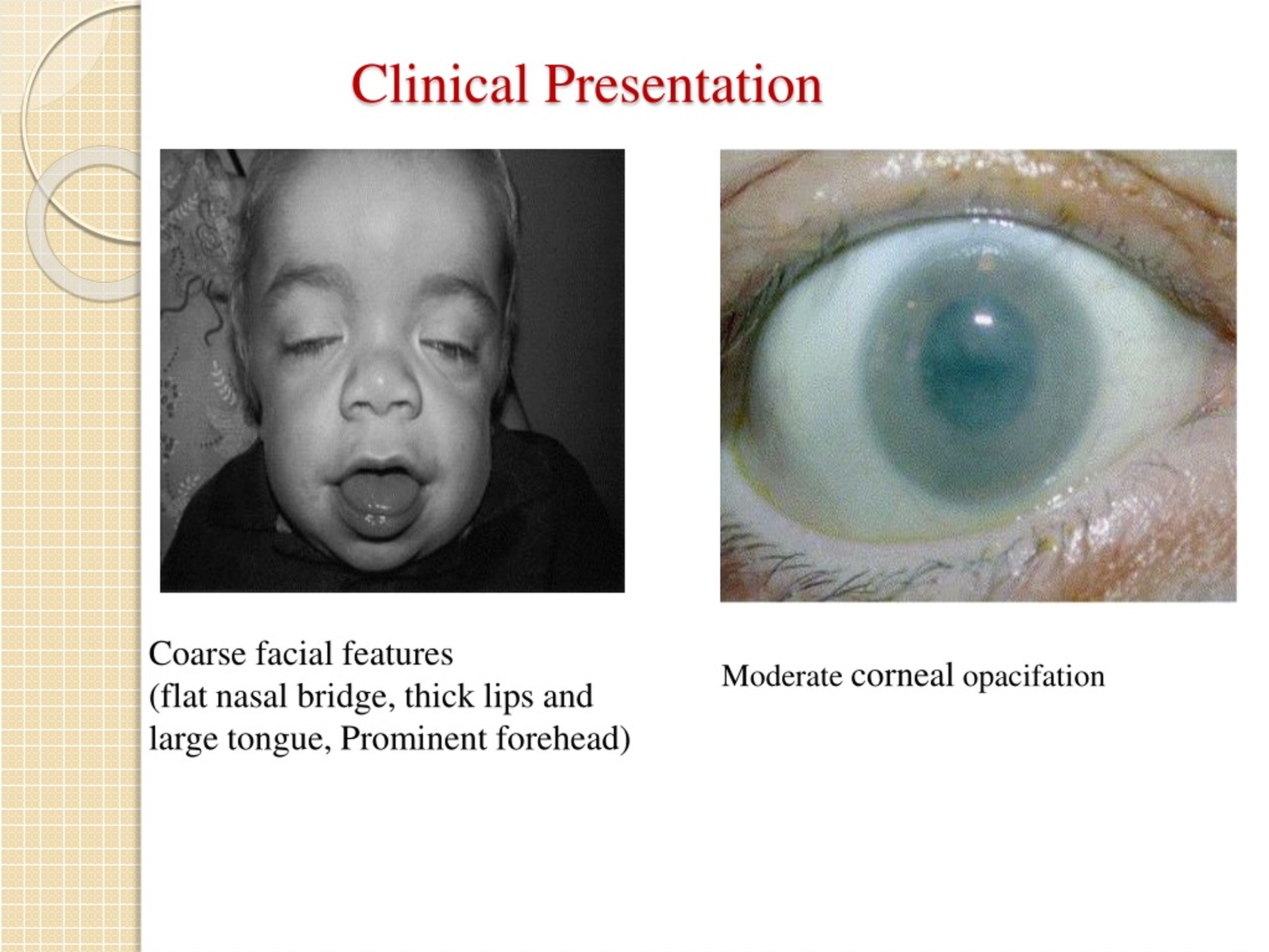 PPT - Mucopolysaccharidosis , Ppt PowerPoint Presentation, Free ...