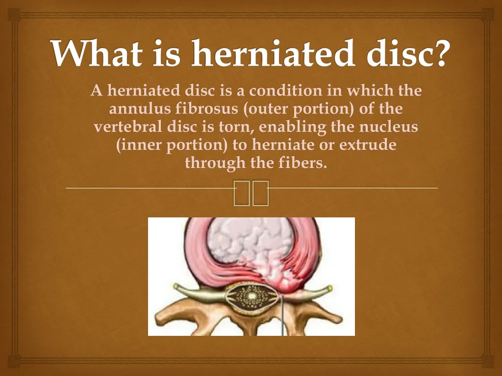 what is herniated disc n.