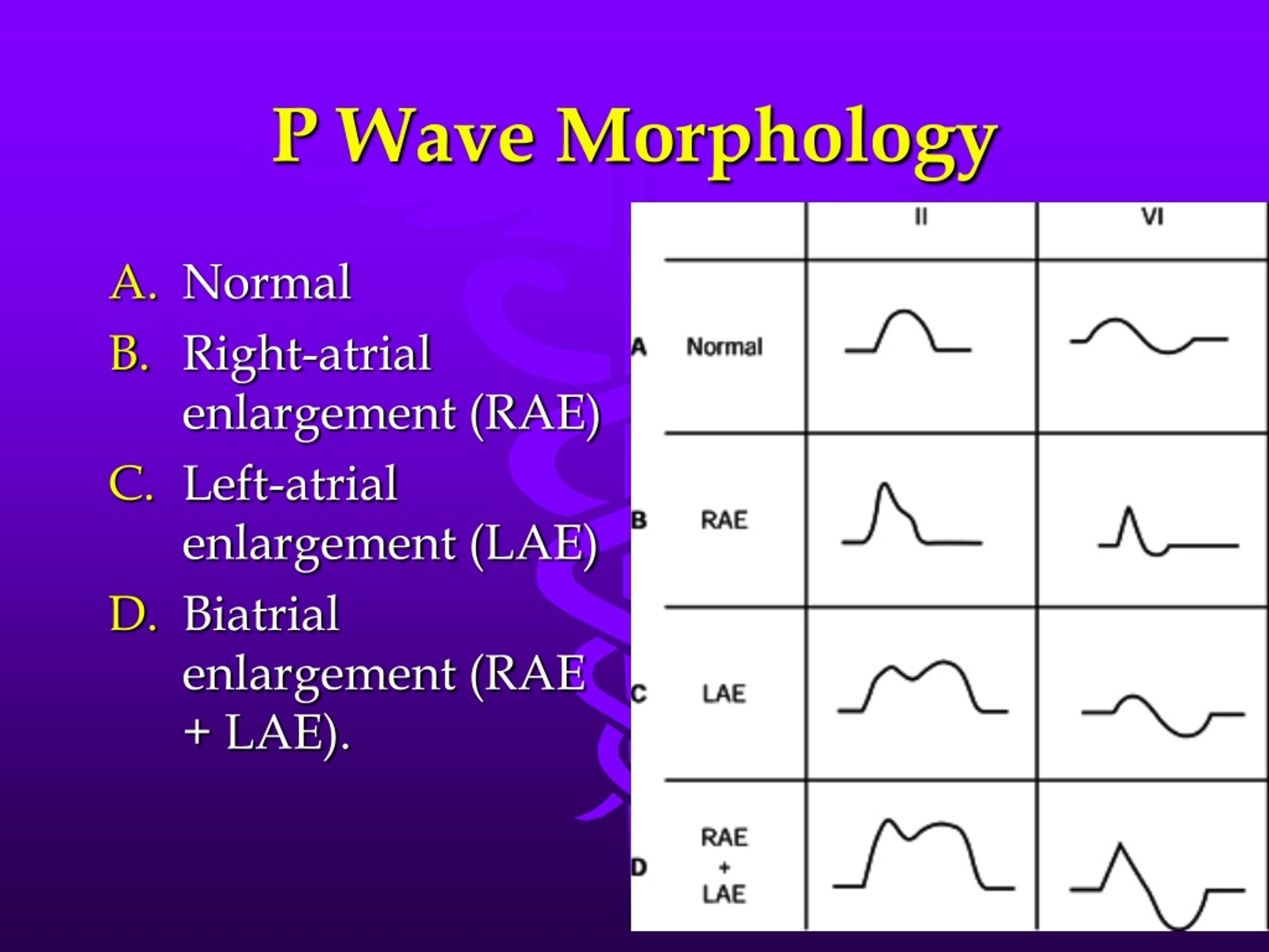 Ppt Practical Electrocardiography Conditions Affecting The Left And Right Side Of The Heart