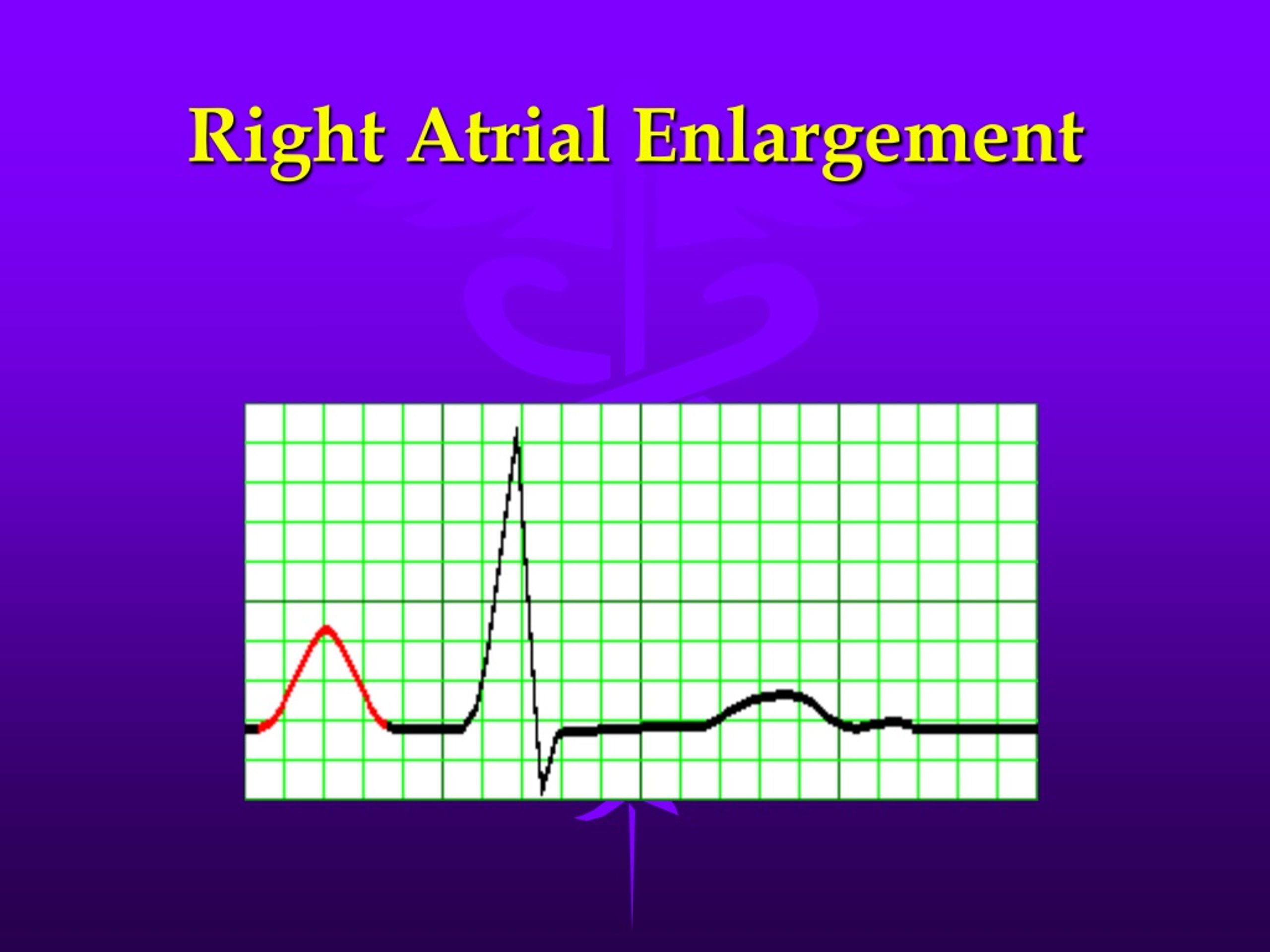 Ppt Practical Electrocardiography Conditions Affecting The Left And Right Side Of The Heart