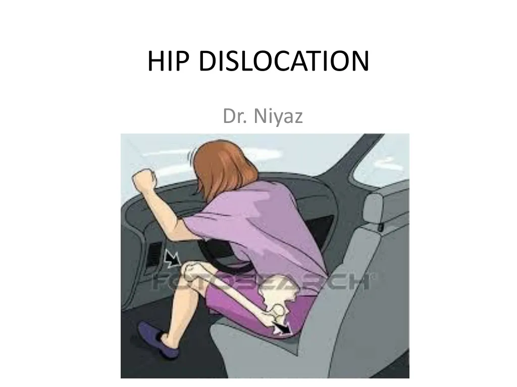 hip dislocation n.