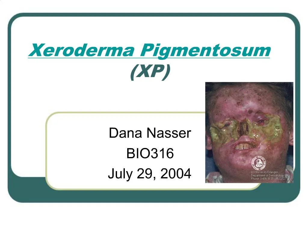 Ppt Xeroderma Pigmentosum Xp Powerpoint Presentation Free