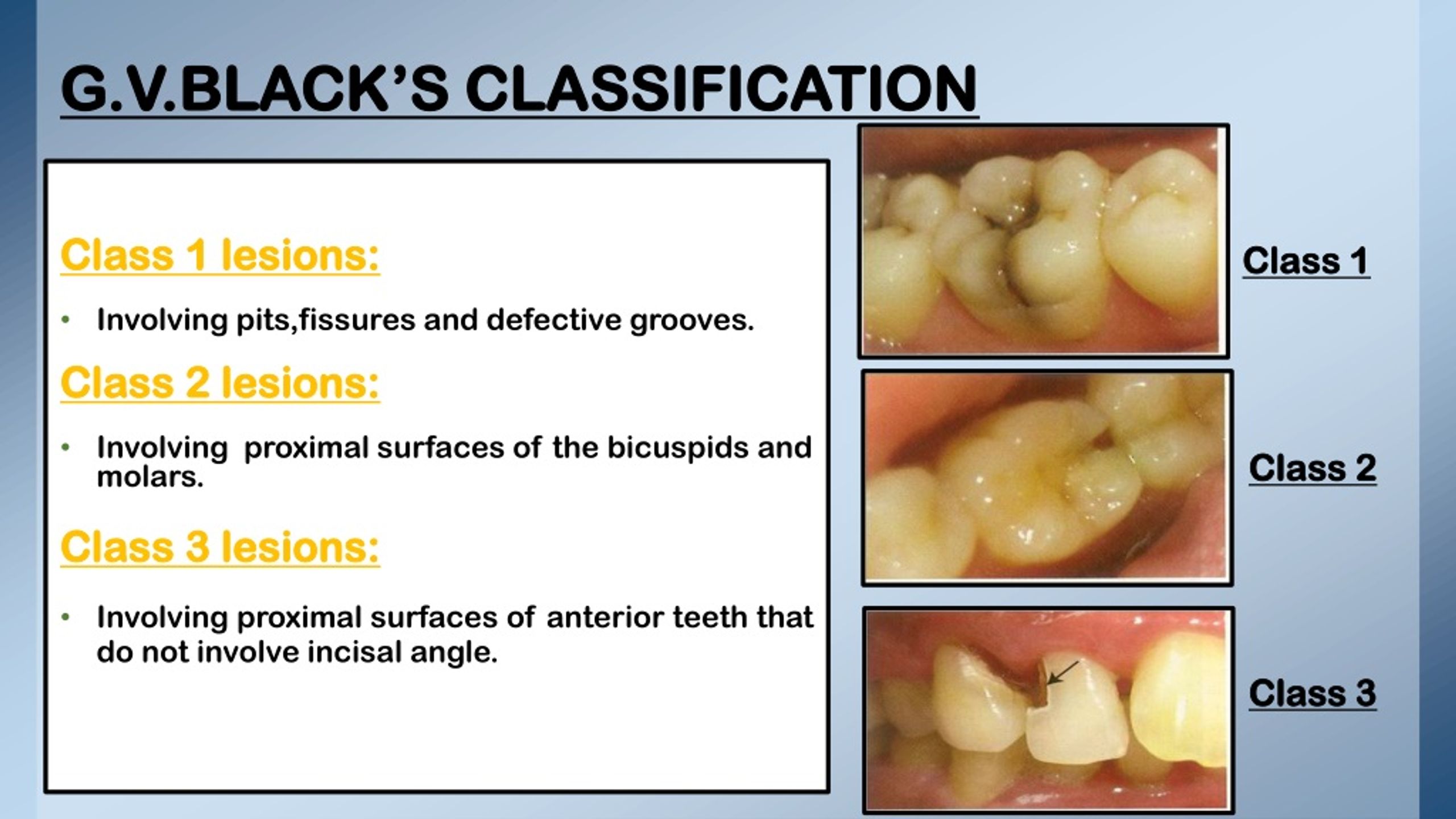 Gv Black Classification Of Dental Caries Dental Caries Dental Porn Sex Picture