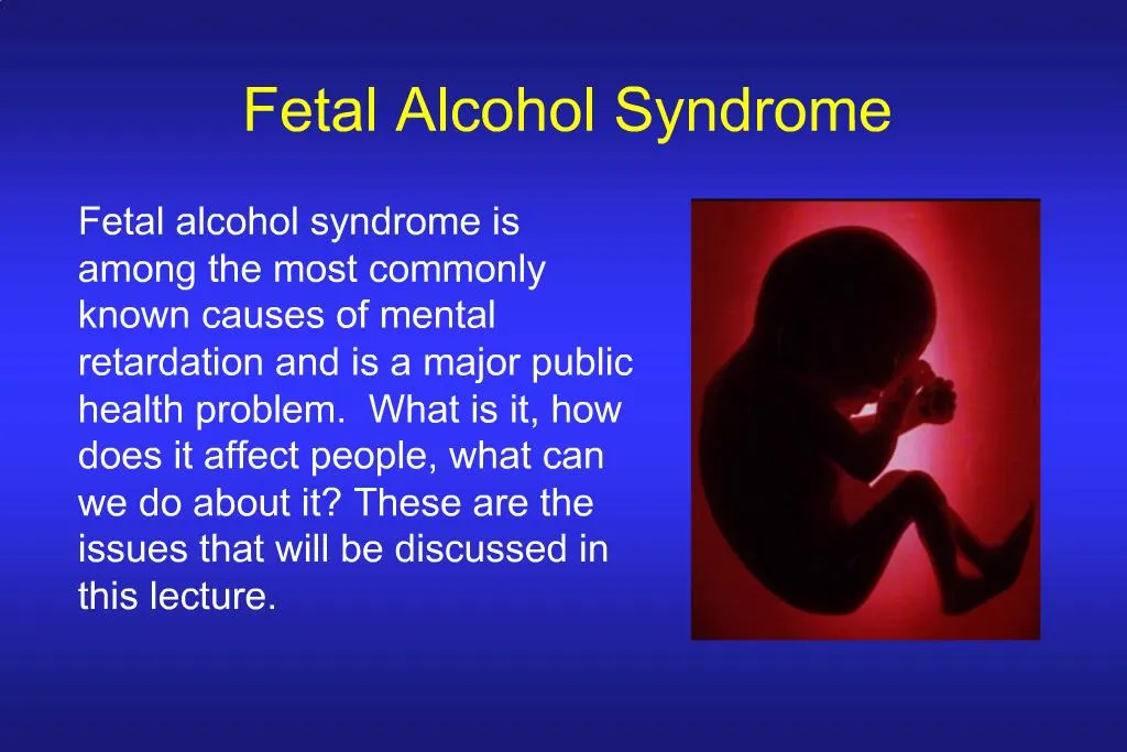 presentation of fetal alcohol