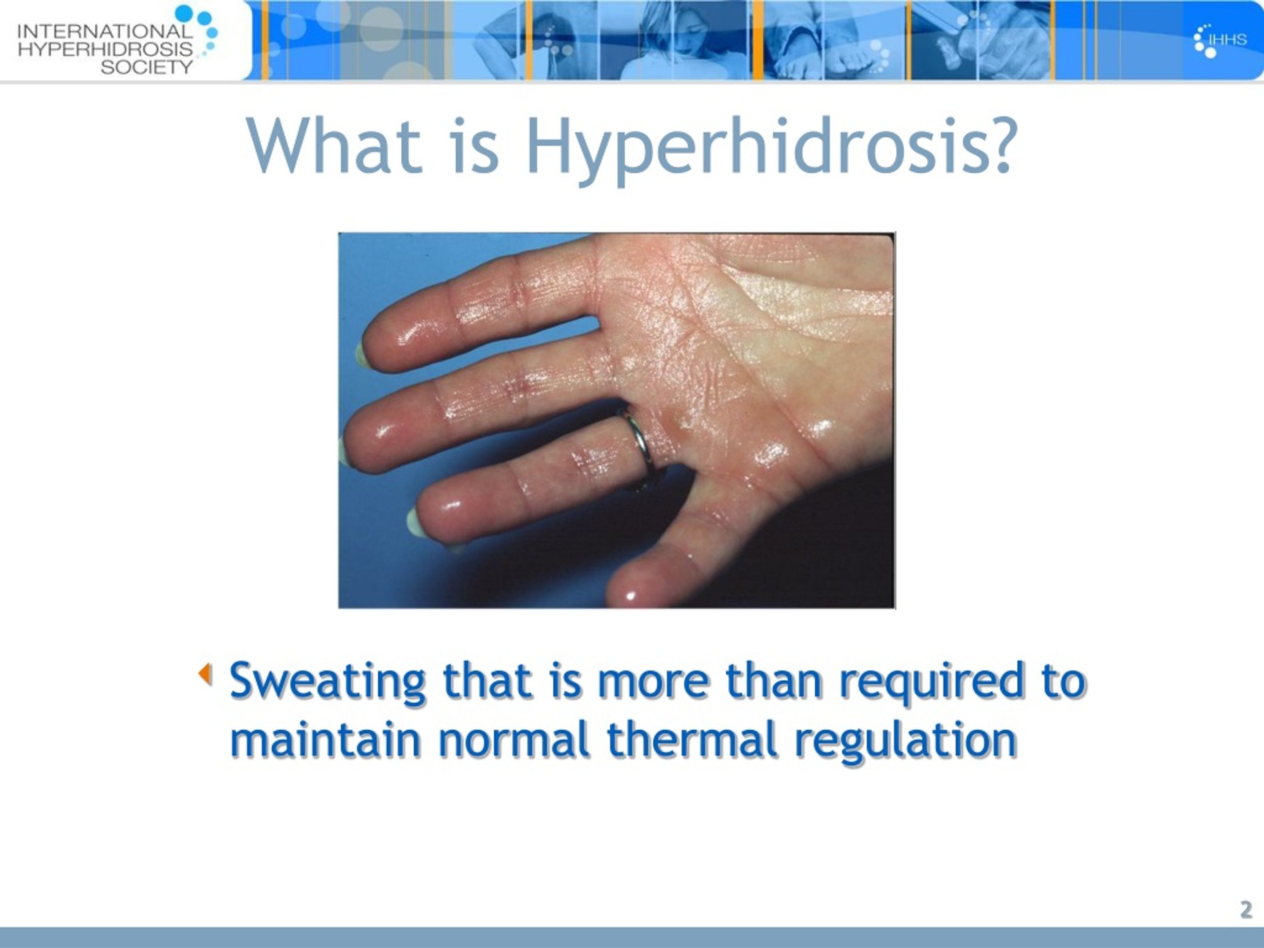 PPT - Hyperhidrosis PowerPoint Presentation, Free Download - ID:140832