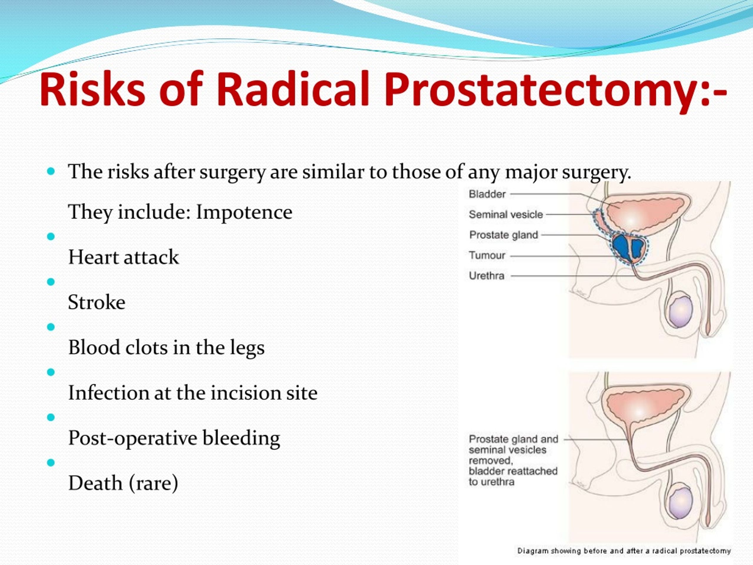 Ppt Radical Prostatectomy Surgery India Powerpoint Presentation Free Download Id1414612