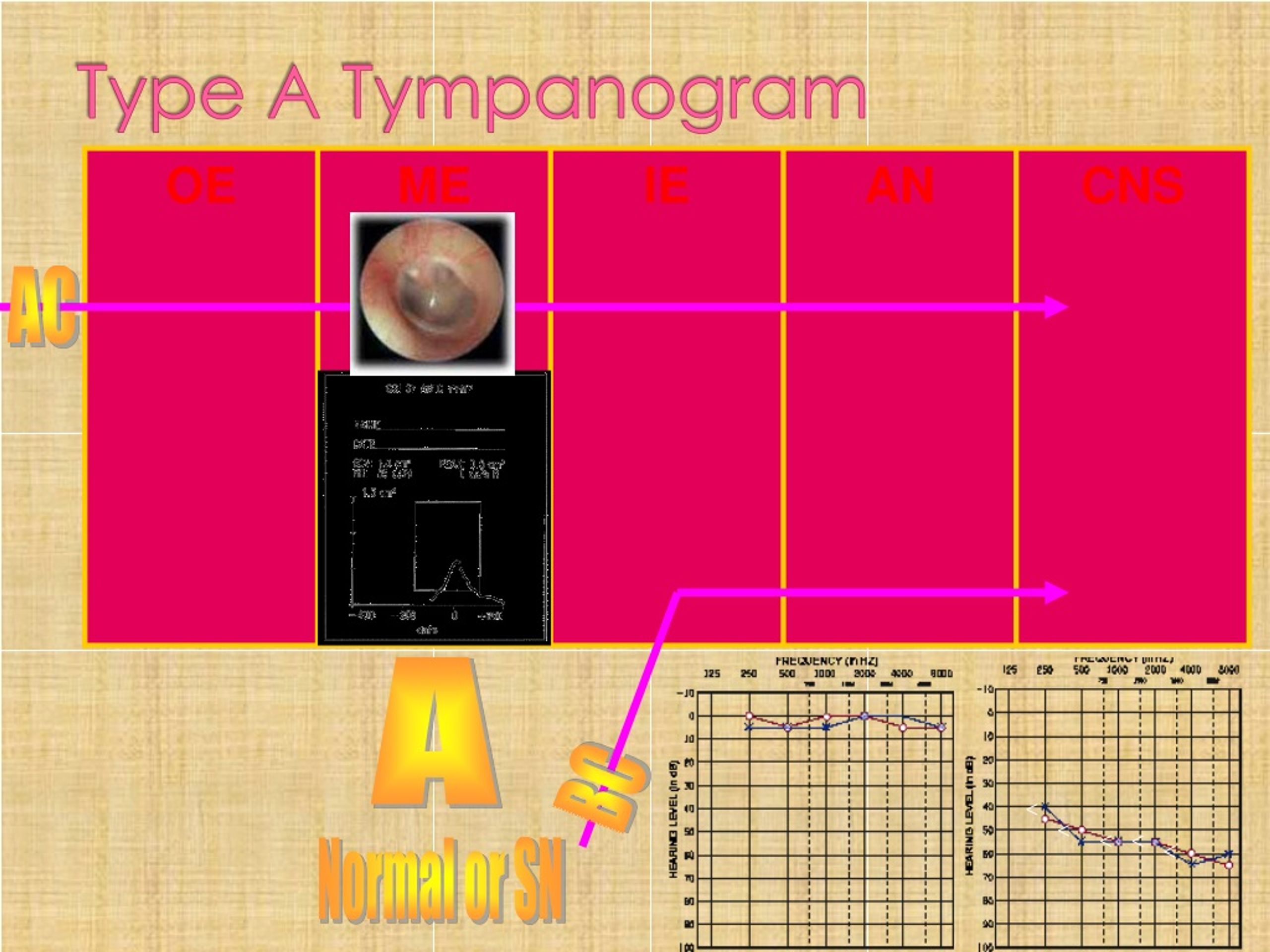 types of tympanograms