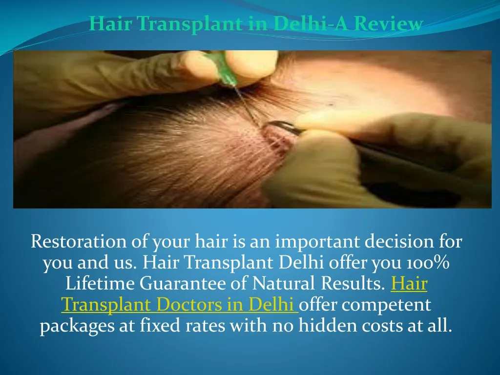 hair transplant in delhi a review n.