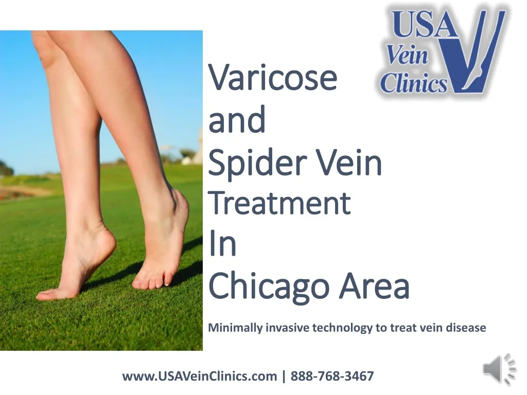 varicose and spider vein treatment in chicago area n.
