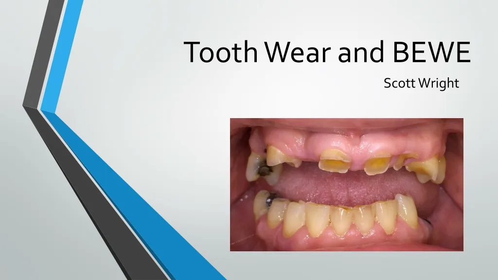 PPT - Tooth Wear and BEWE PowerPoint Presentation, free download - ID ...