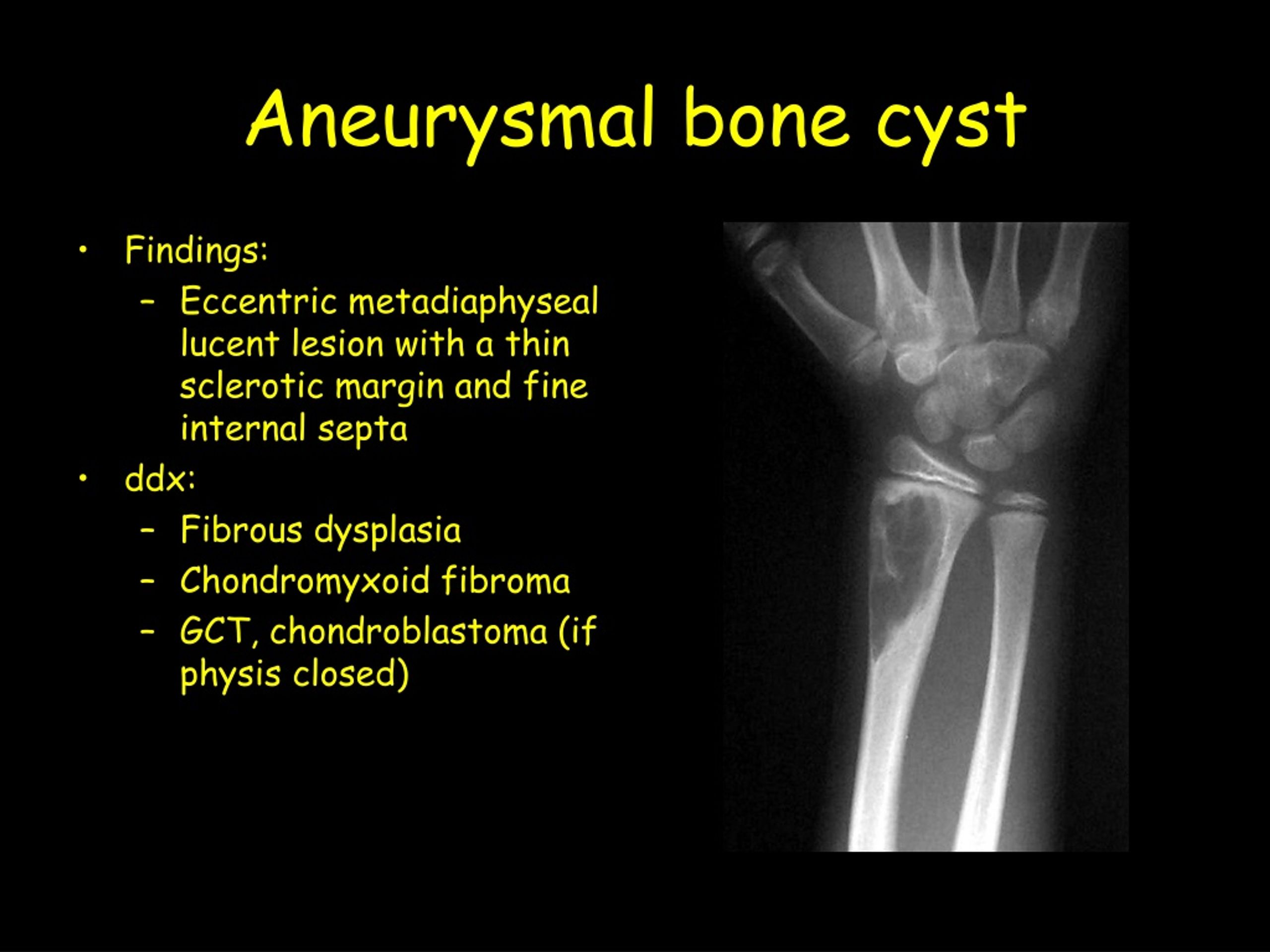 Ppt Aneurysmal Bone Cyst Powerpoint Presentation Free Download Id162070 5229