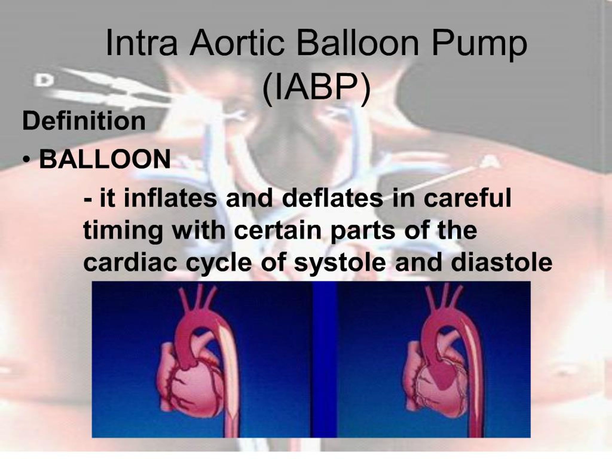 intra aortic balloon pump nursing