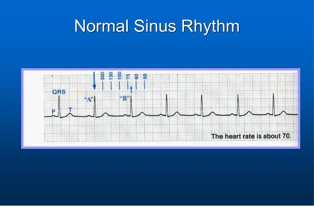 Ppt - Normal Sinus Rhythm Powerpoint Presentation, Free Download - Id 