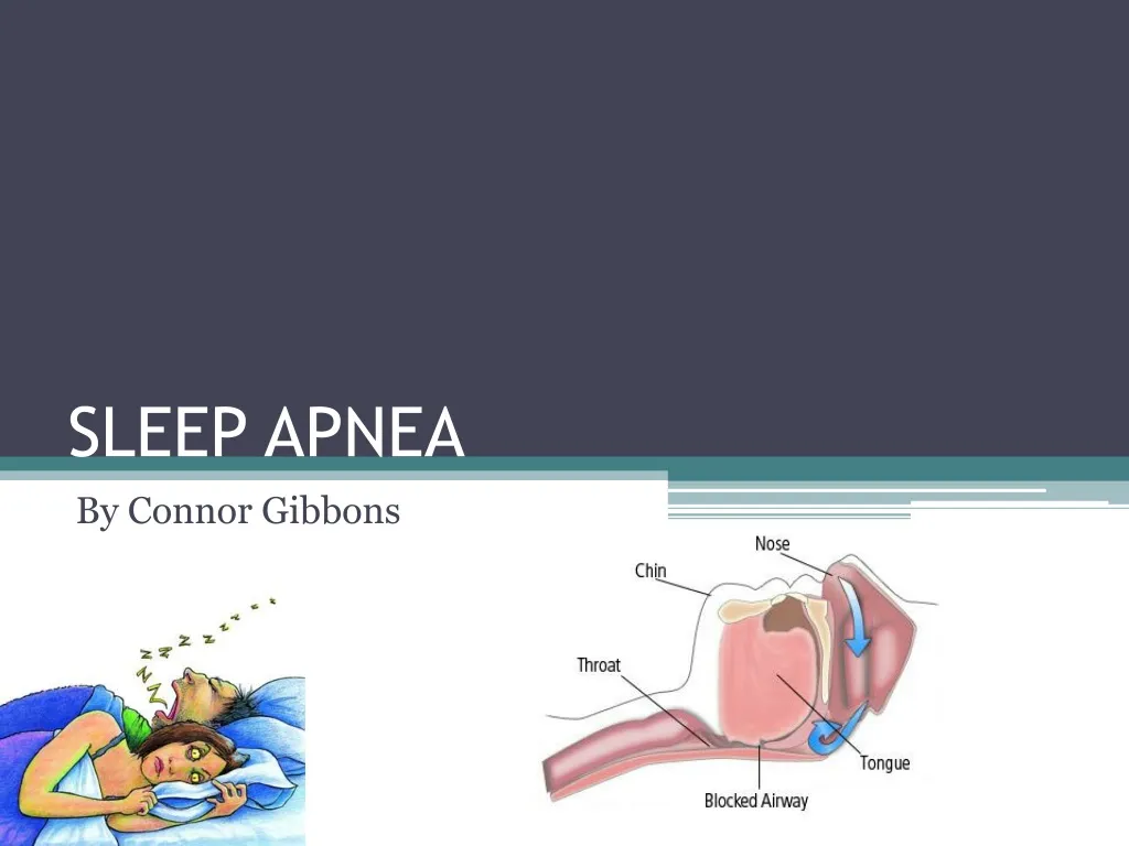 sleep apnea n.