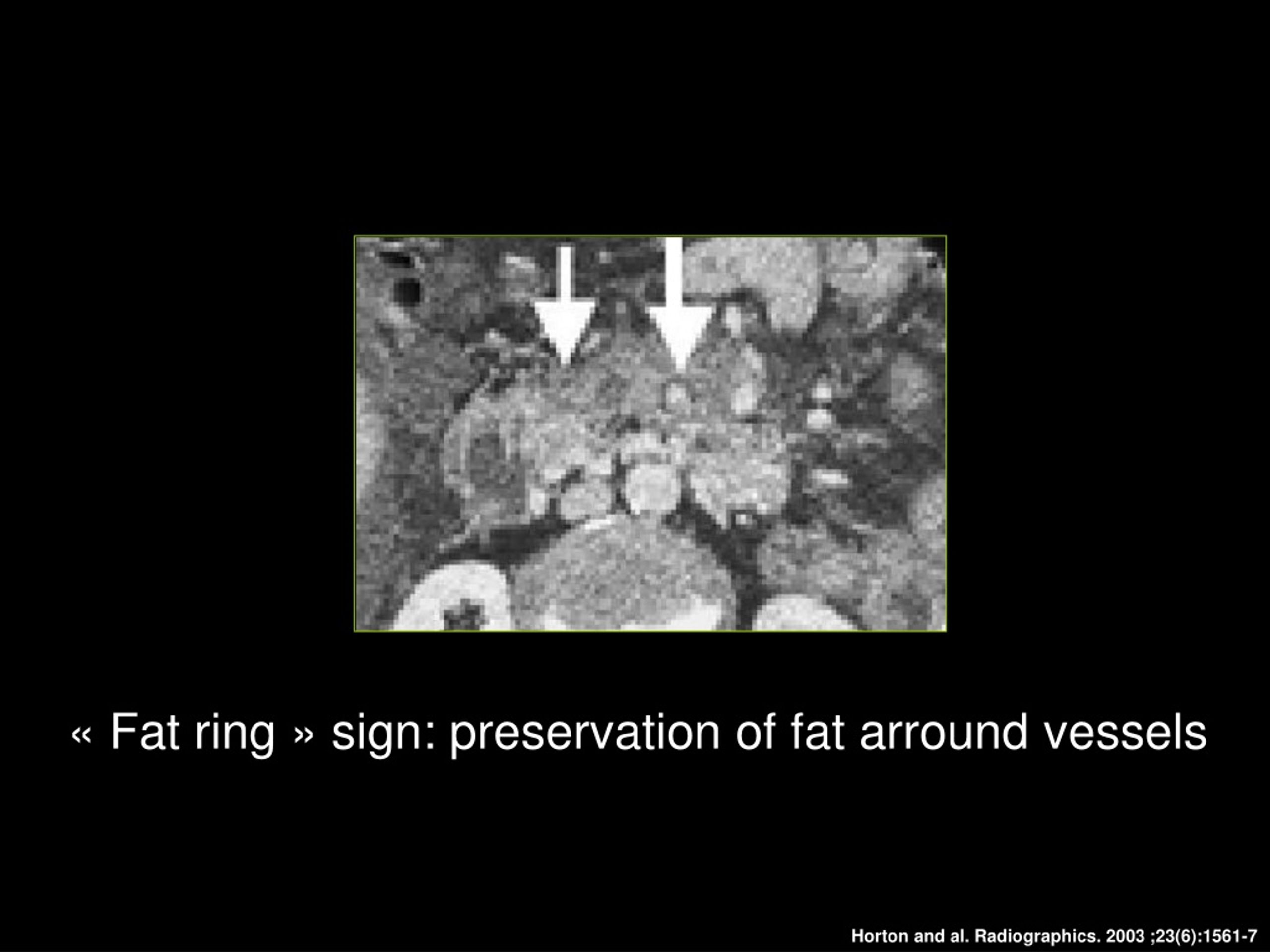 fat ring sign preservation of fat arround vessels l