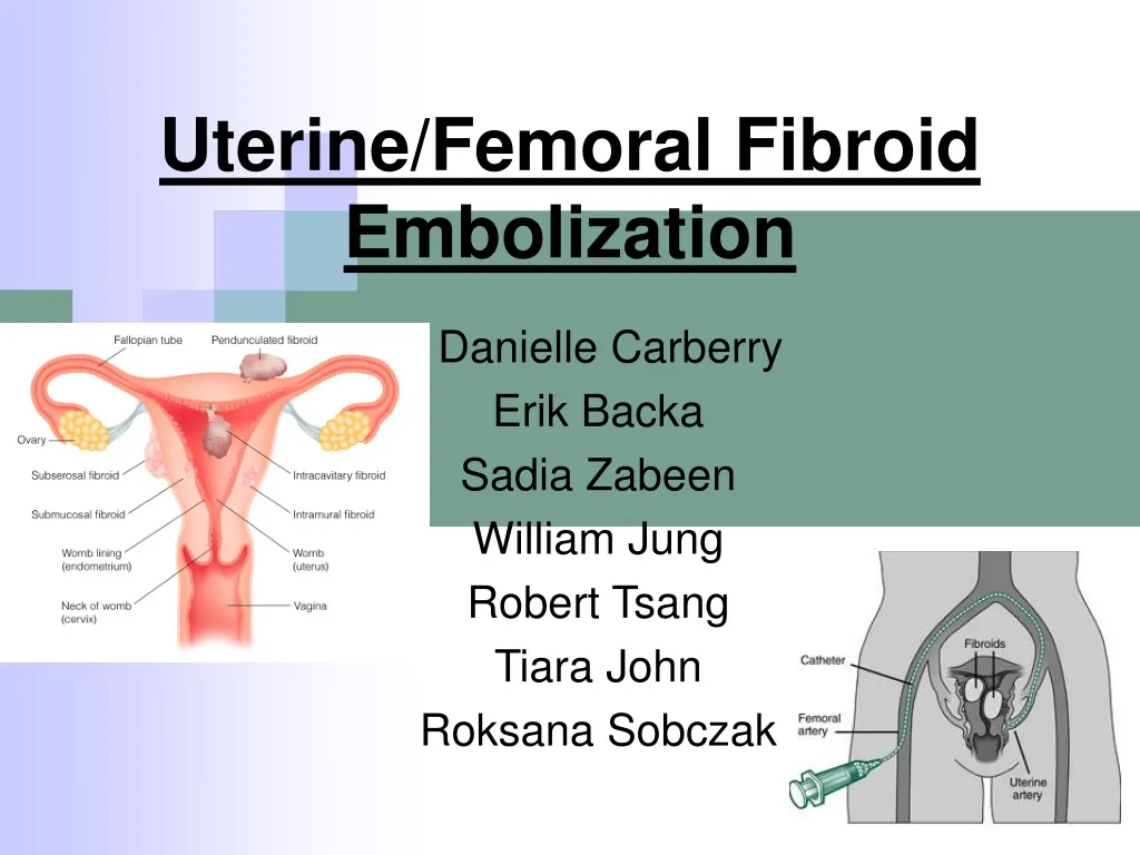 PPT Uterine/Femoral Fibroid Embolization PowerPoint Presentation