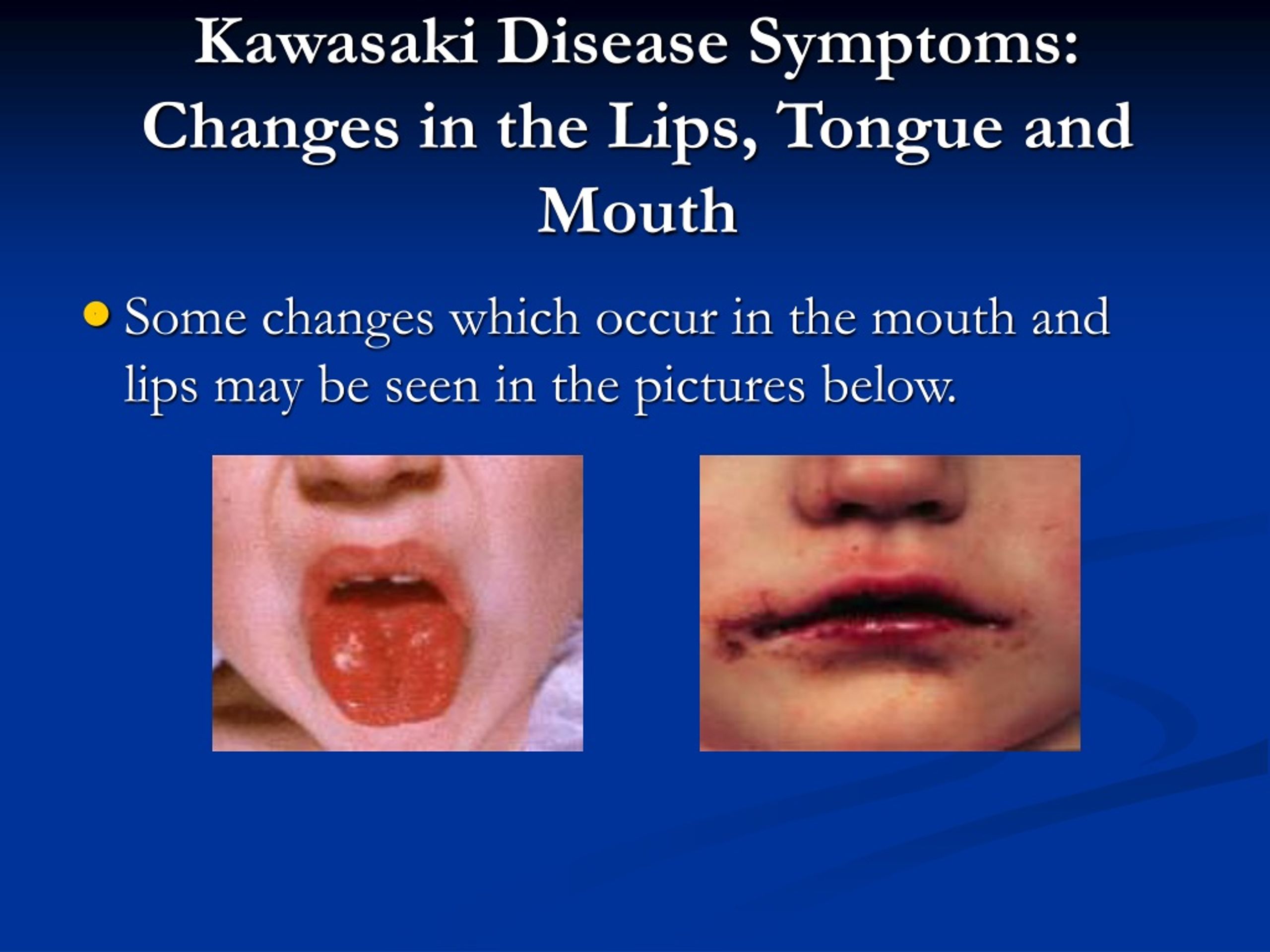 Kawasaki Disease Tongue