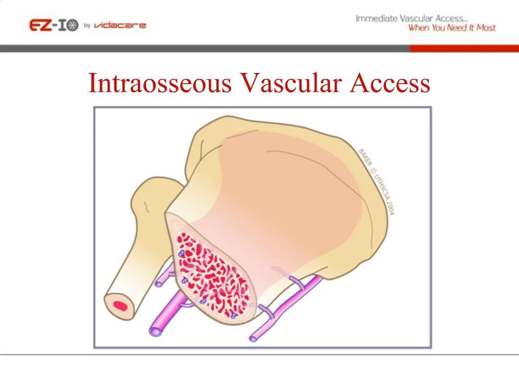 PPT - Intraosseous Vascular Access PowerPoint Presentation, Free ...