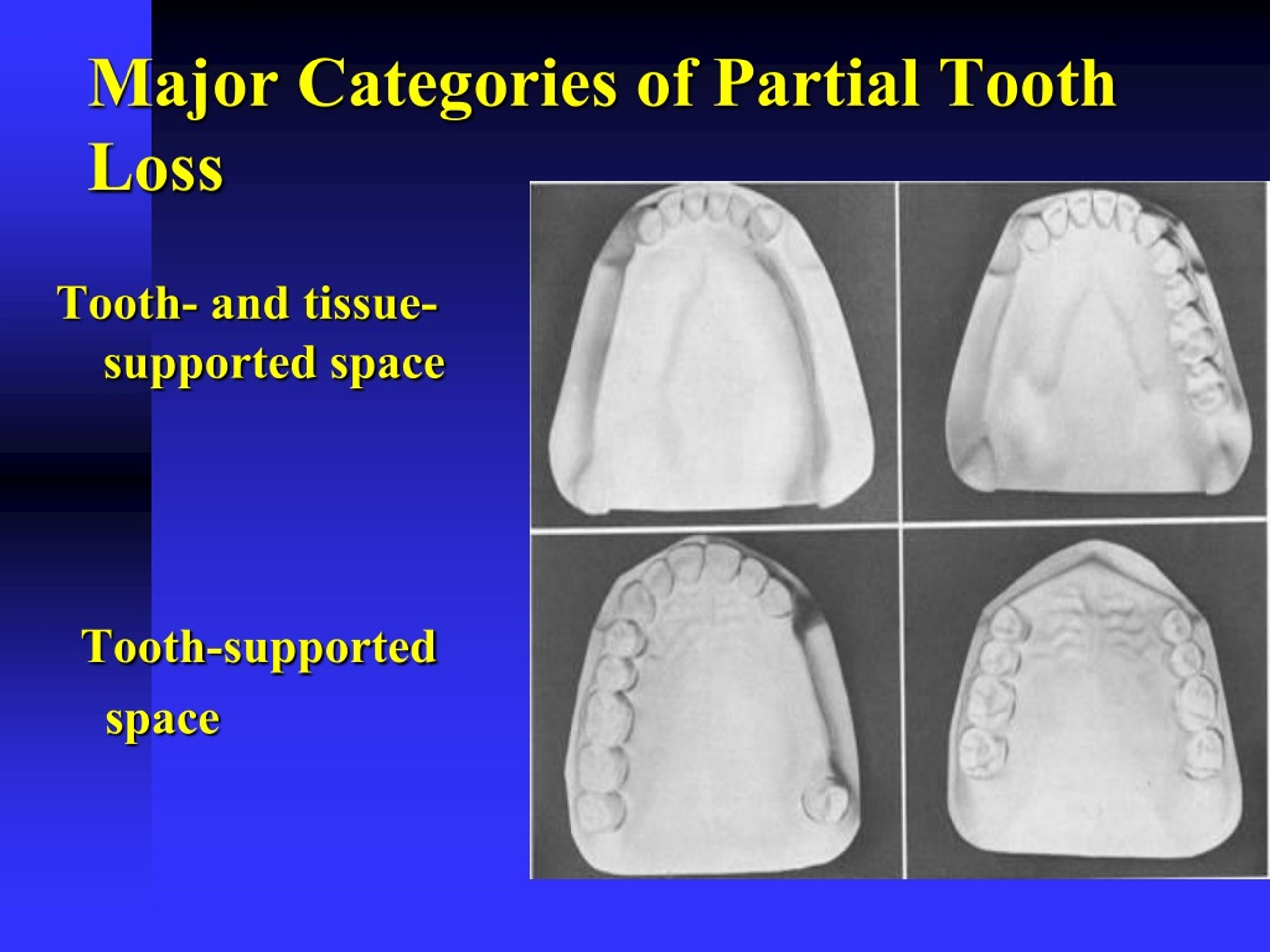 PPT Introduction to Removable Partial Prosthodontics PowerPoint