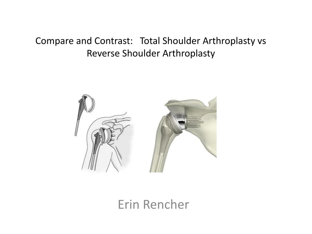 compare and contrast total shoulder arthroplasty vs reverse shoulder arthroplasty n.