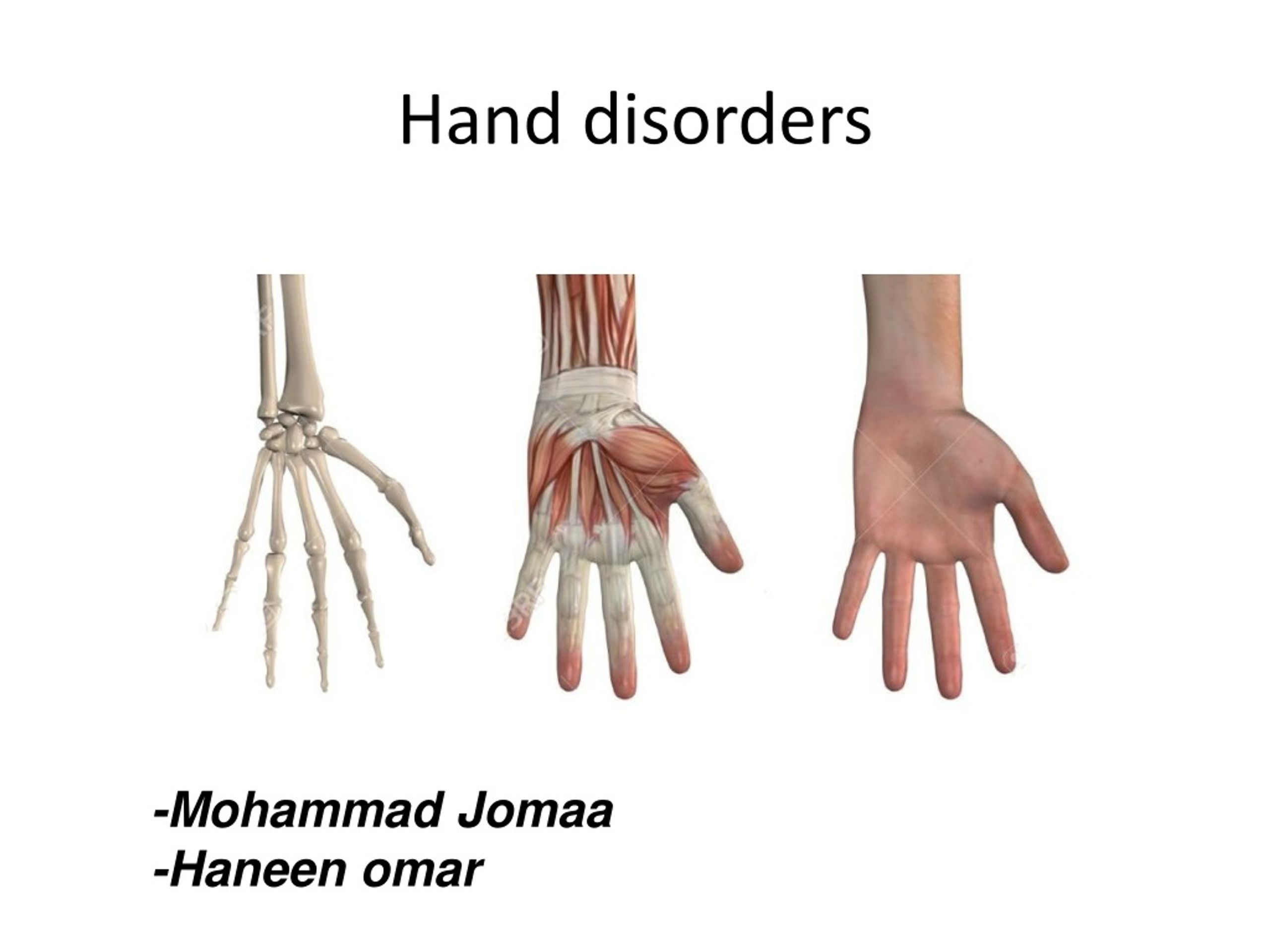 Ppt Hand Disorders Powerpoint Presentation Free Download Id273638