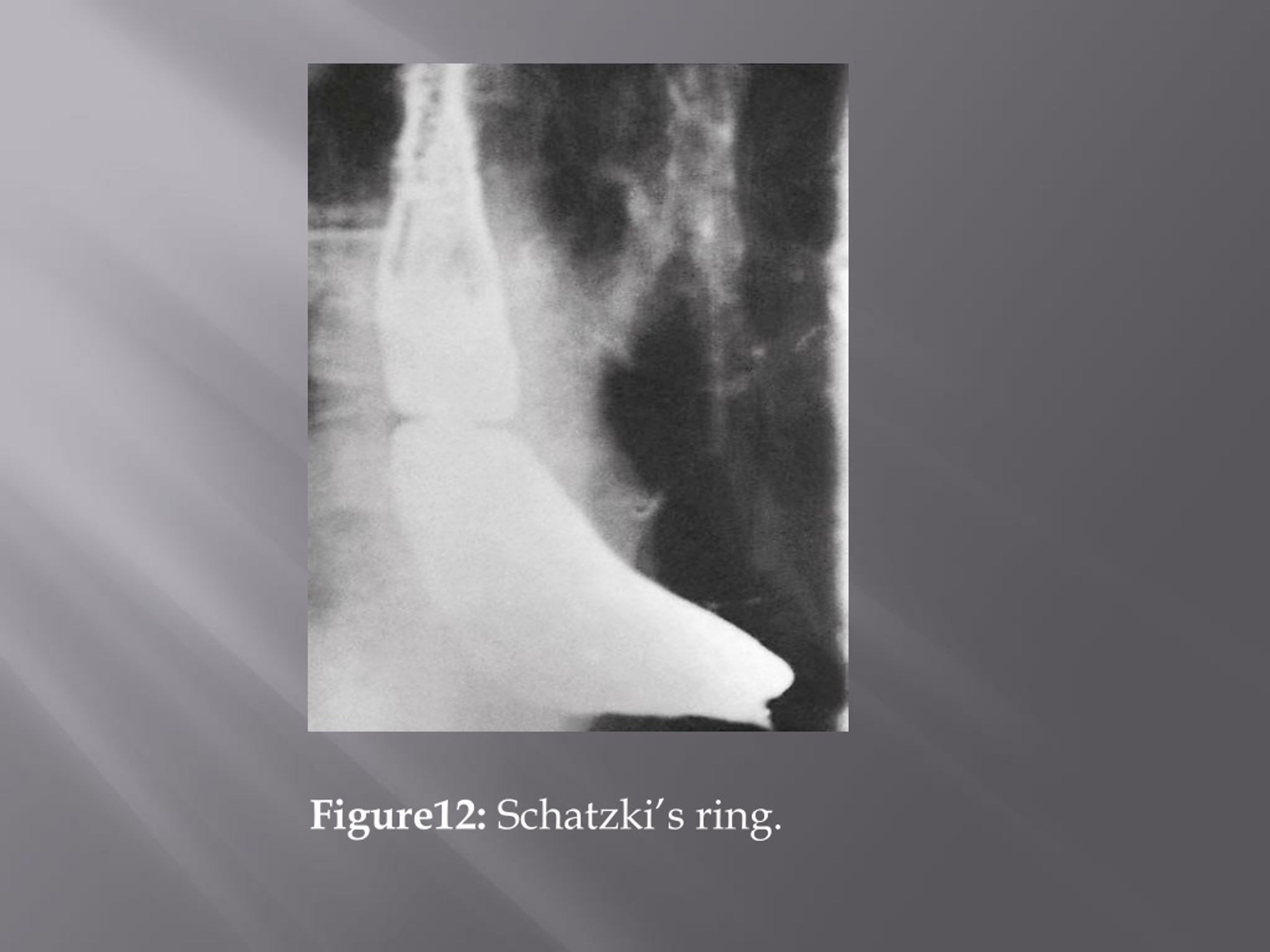Barium esophagogram in various esophageal diseases: A pictorial essay. -  Abstract - Europe PMC