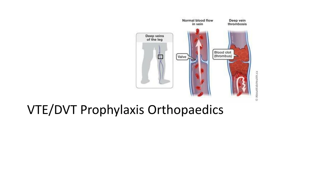 Ppt Vte Dvt Prophylaxis Orthopaedics Powerpoint Presentation Free Download Id 283614