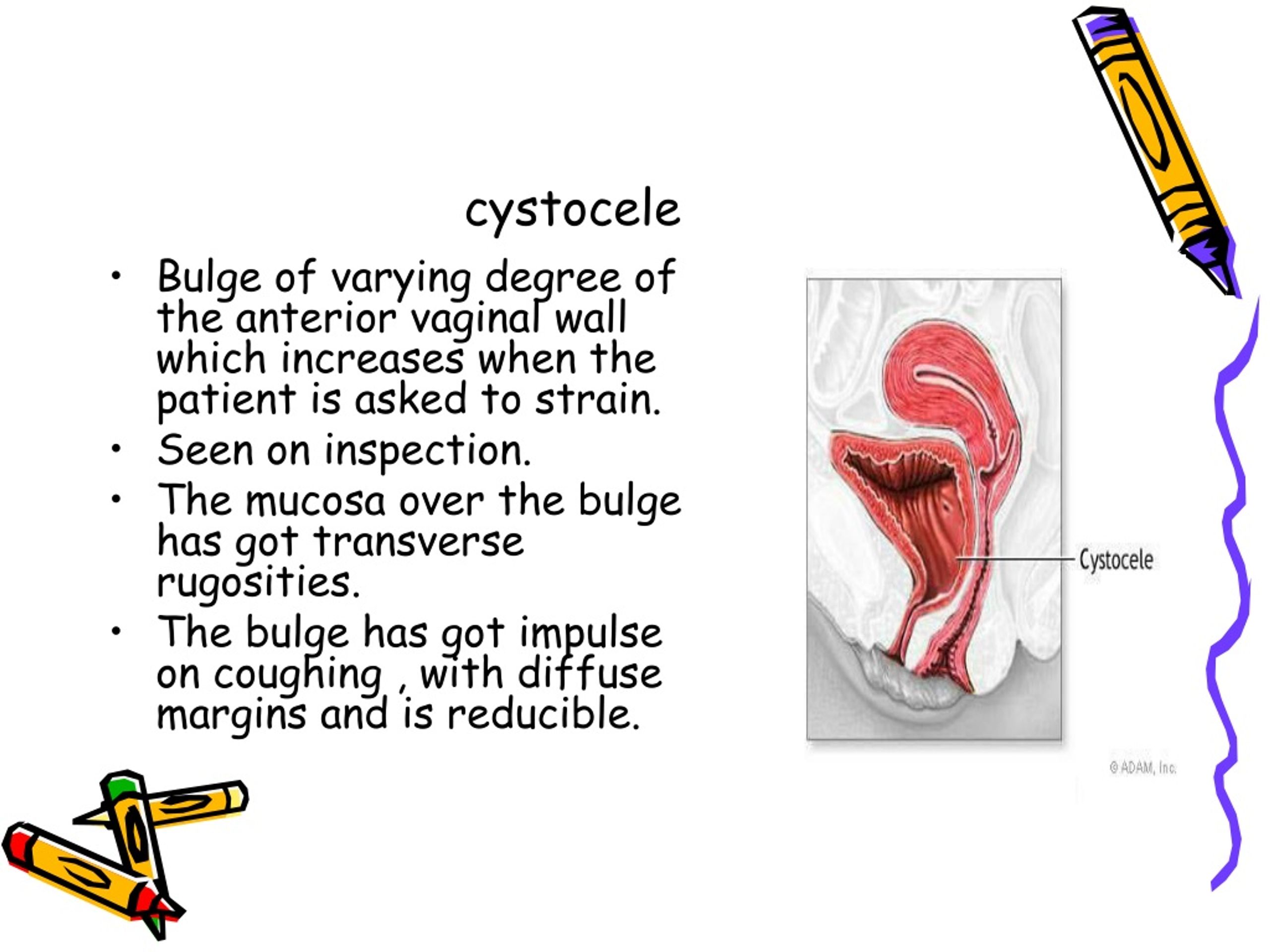 Ppt Genital Prolapse Powerpoint Presentation Free Download Id 325270