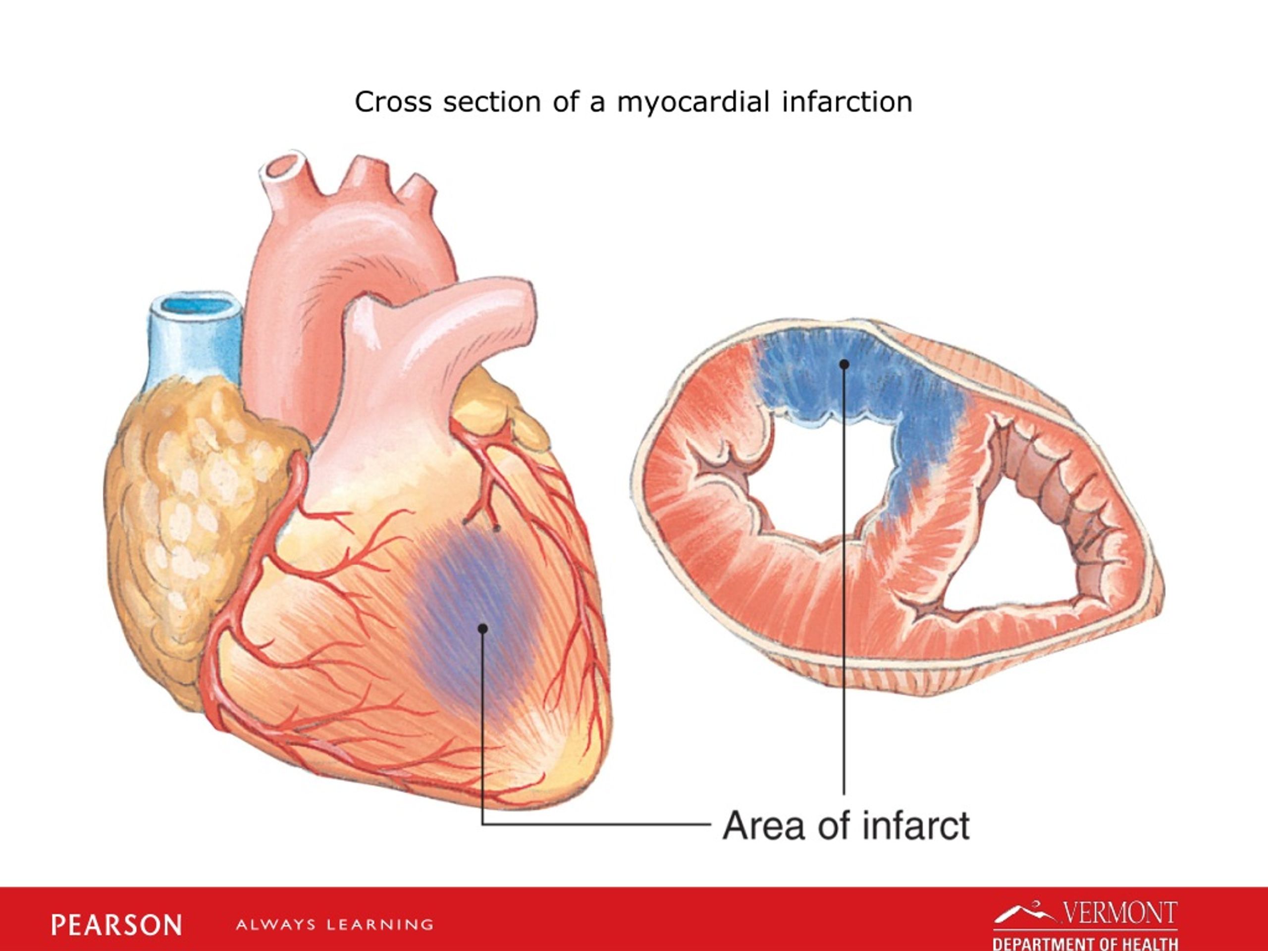 PPT - Cardiovascular Emergencies: Chest Pain and Acute Coronary ...