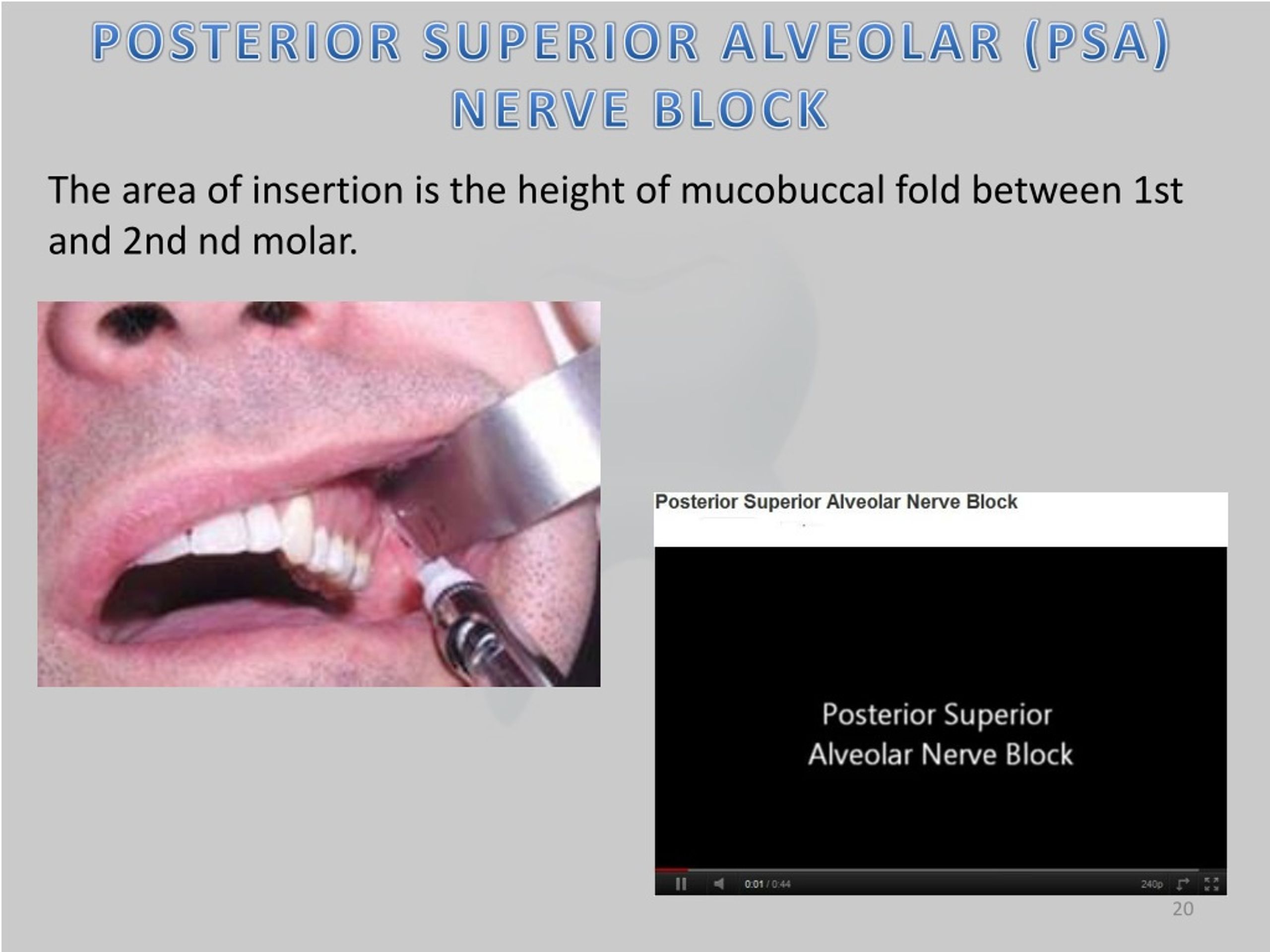 Superior Alveolar Nerve Block Medizzy vrogue.co