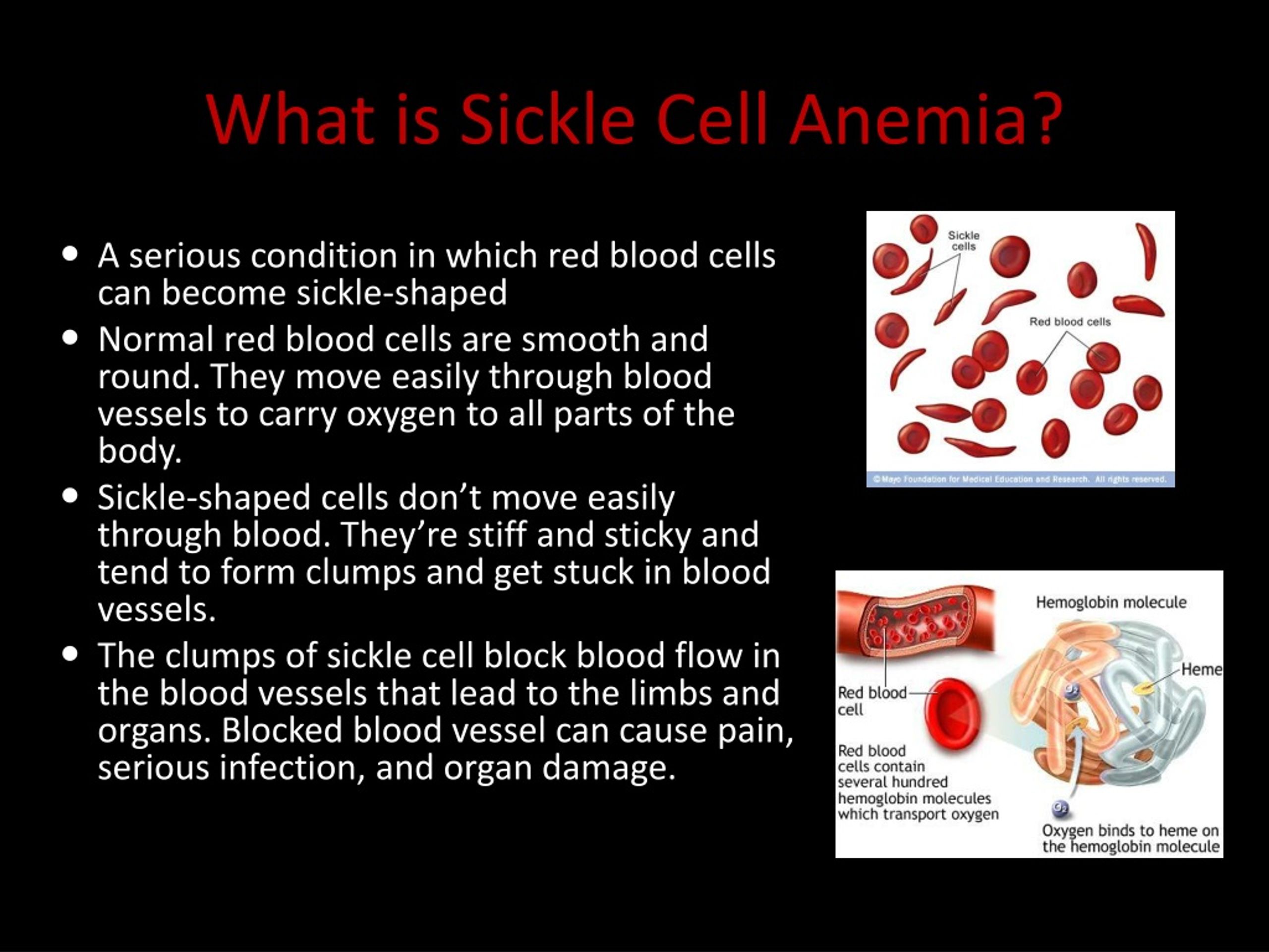 powerpoint presentation on sickle cell anemia