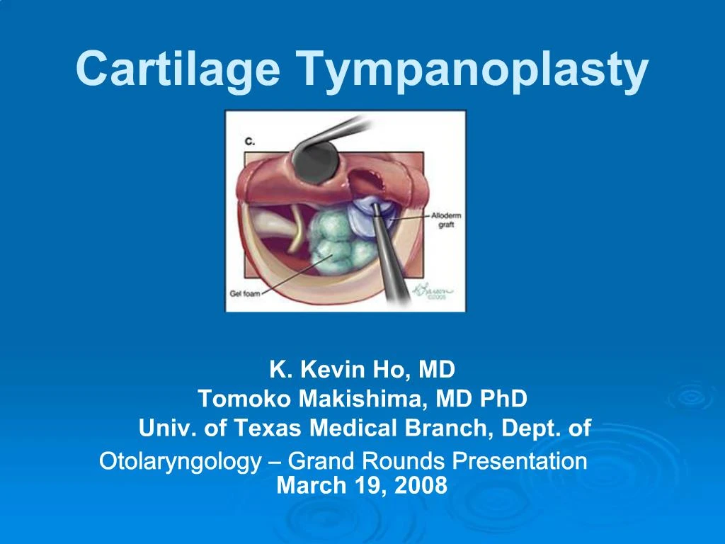PPT Cartilage Tympanoplasty PowerPoint Presentation, free download