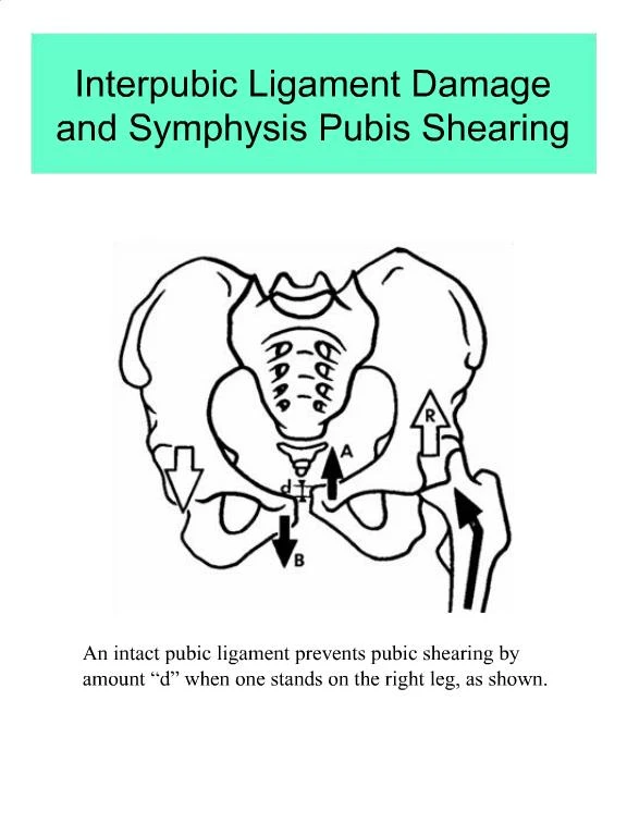 PPT - Interpubic Ligament Damage and Symphysis Pubis Shearing ...