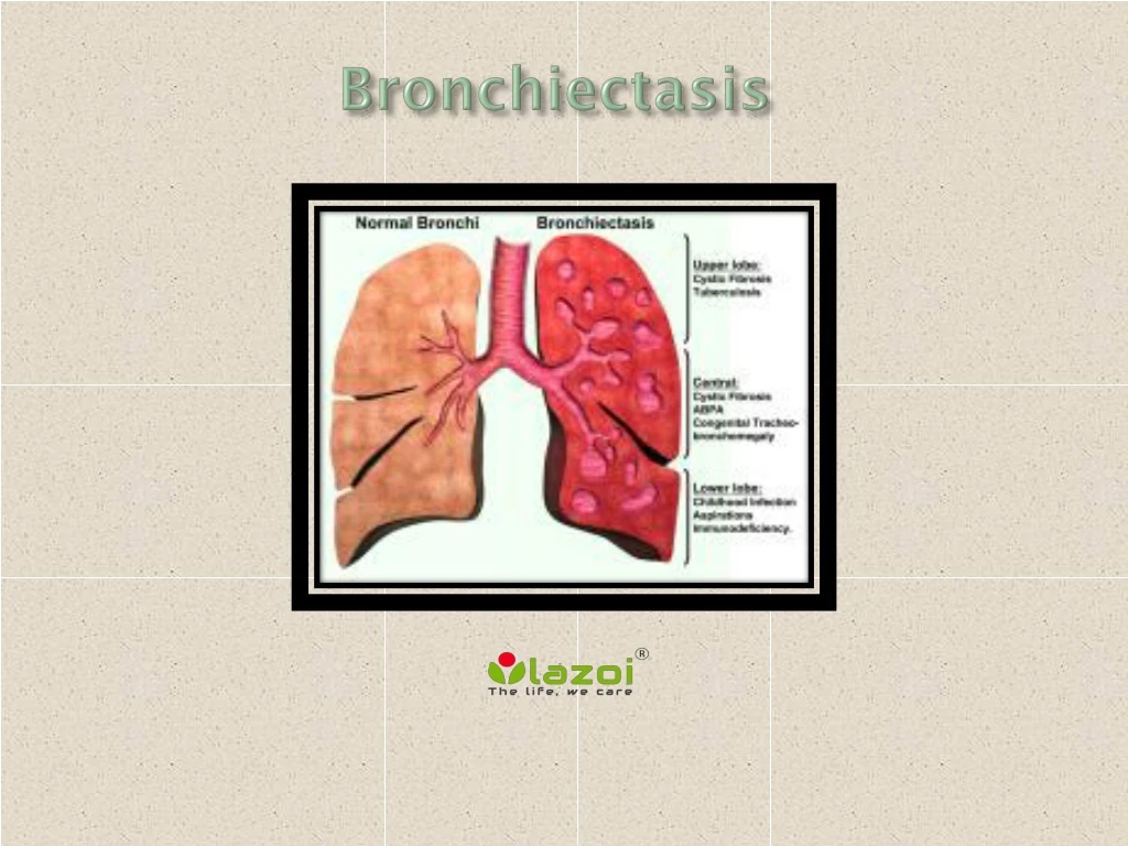 bronchiectasis n.