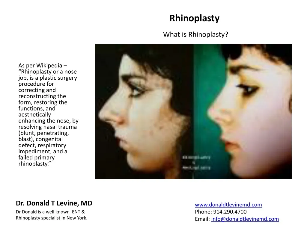 as per wikipedia rhinoplasty or a nose n.