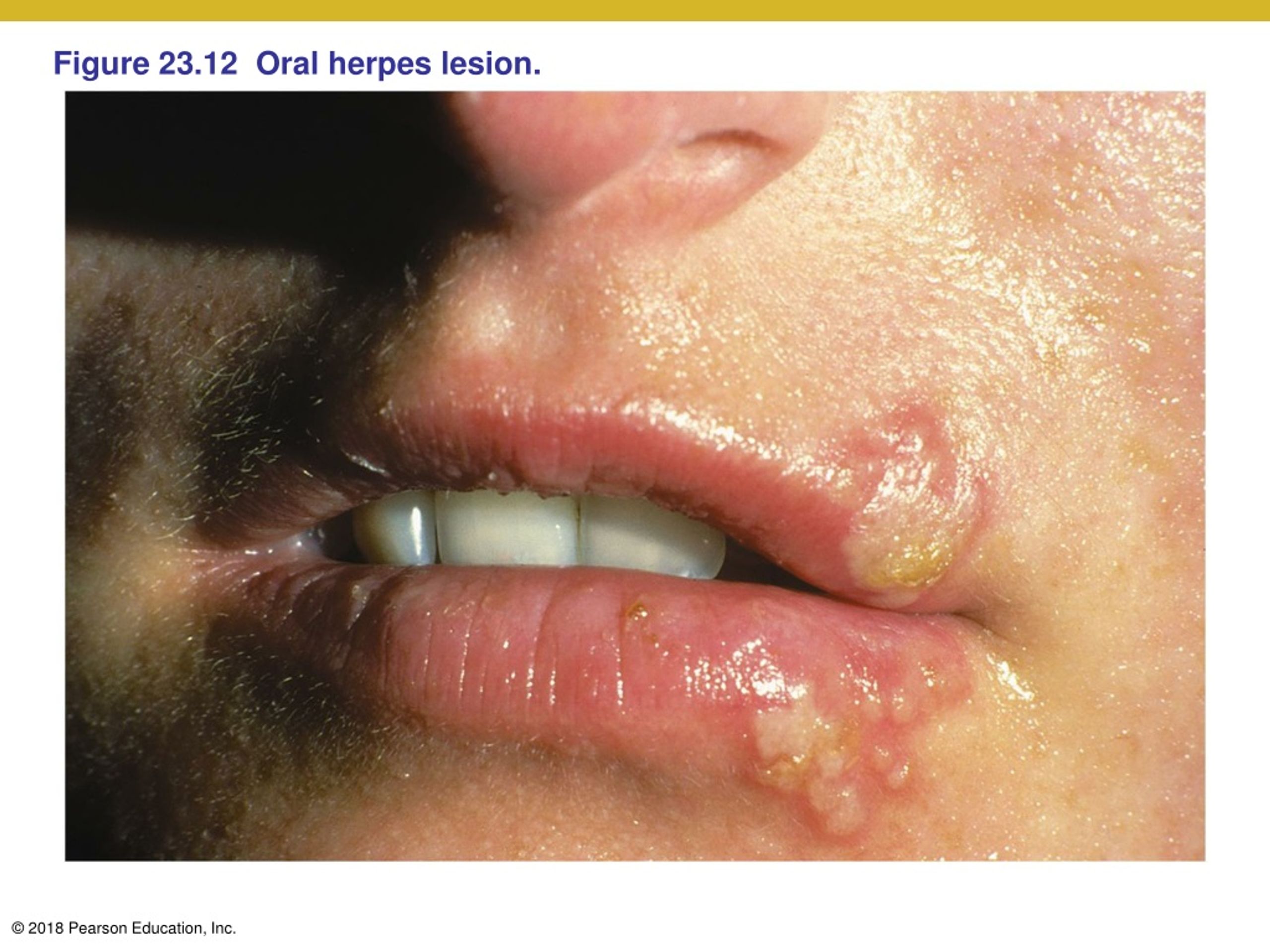 Figure 23.12 Oral herpes lesion. 