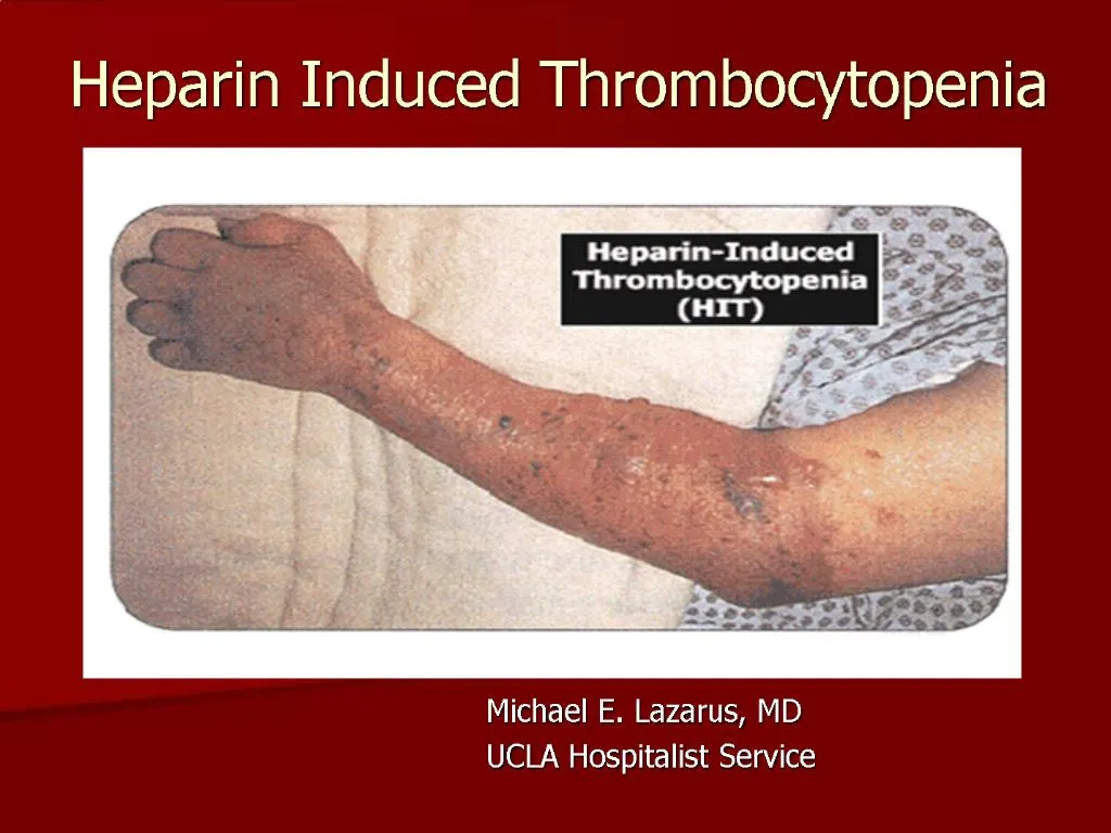 PPT - Heparin Induced Thrombocytopenia PowerPoint Presentation, free ...