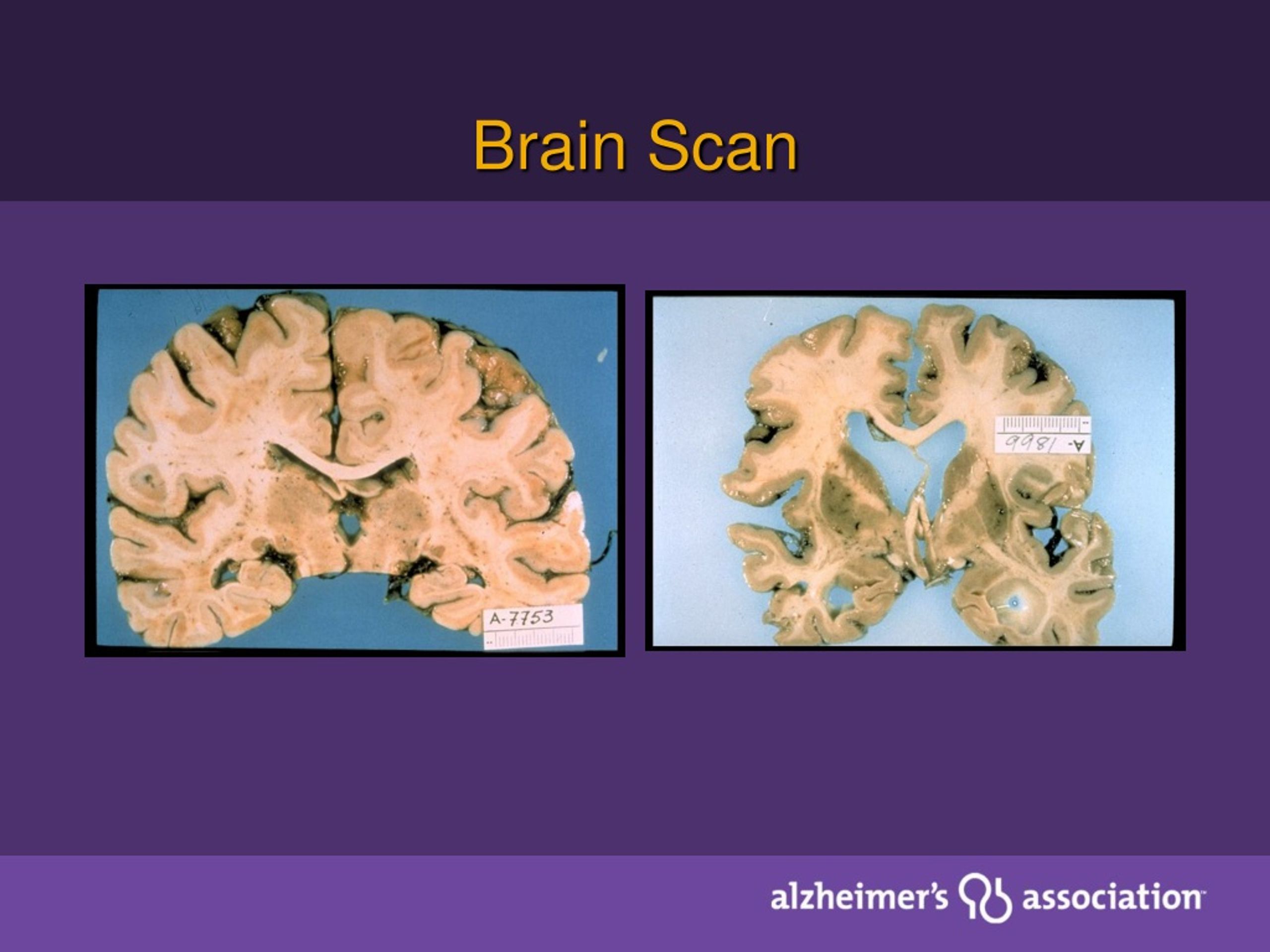 PPT - Fundamentals Of Dementia Care For Health Facility Personnel ...