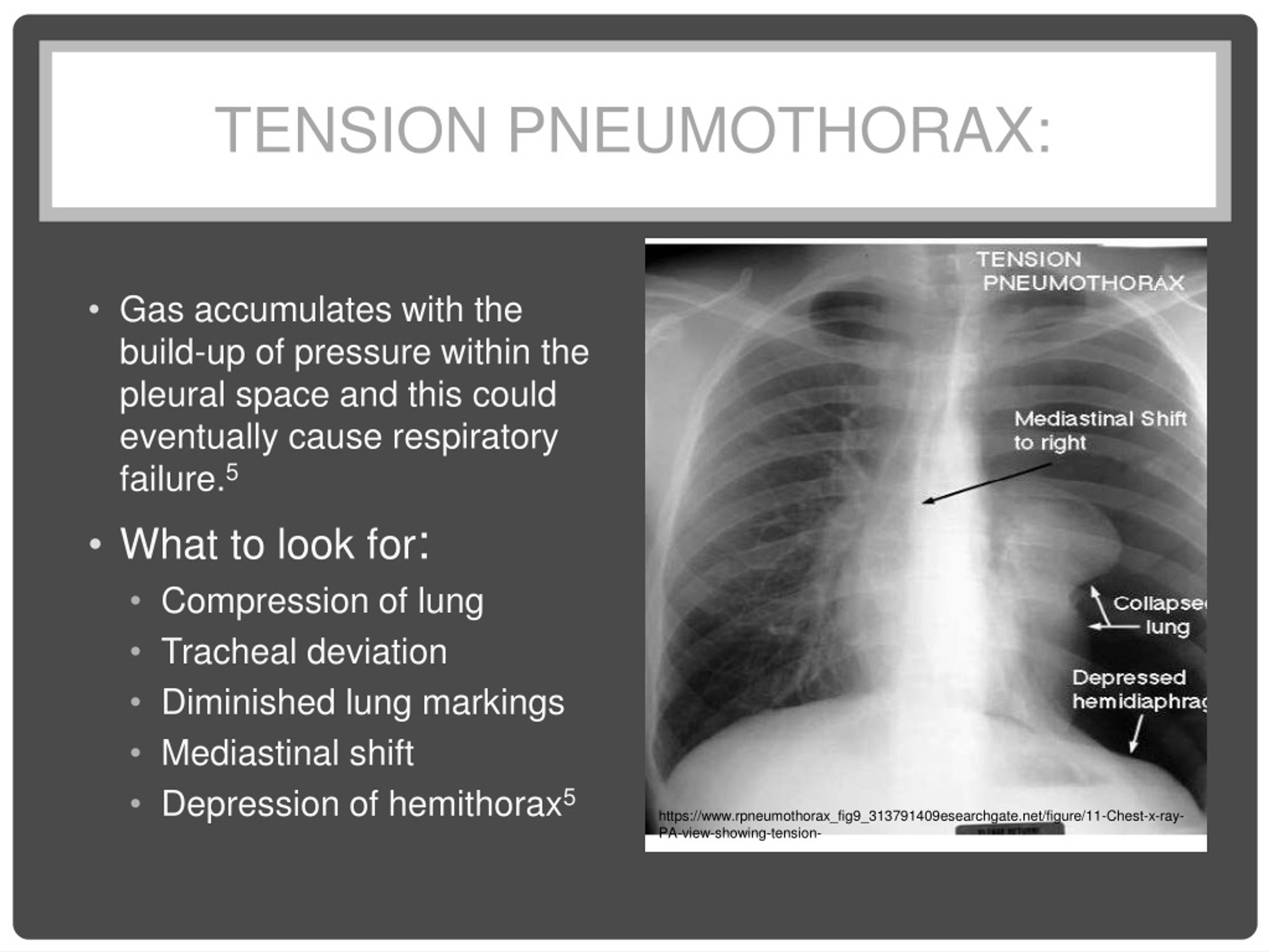Tension Pneumothorax Tracheal Deviation