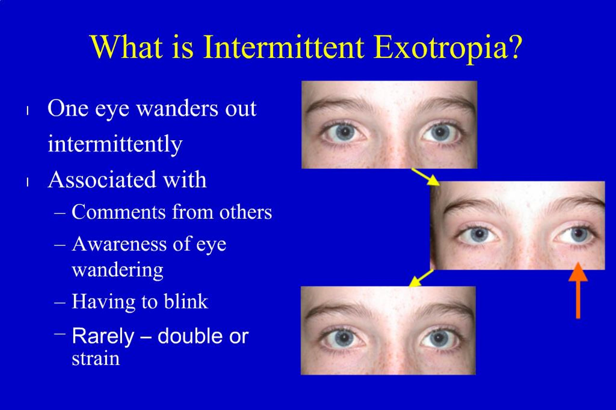 Ppt Improvement Of Depth Perception Following Surgery For Intermittent Exotropia Wandering Eyes Adams We Leske Da Hatt S Powerpoint Presentation Id
